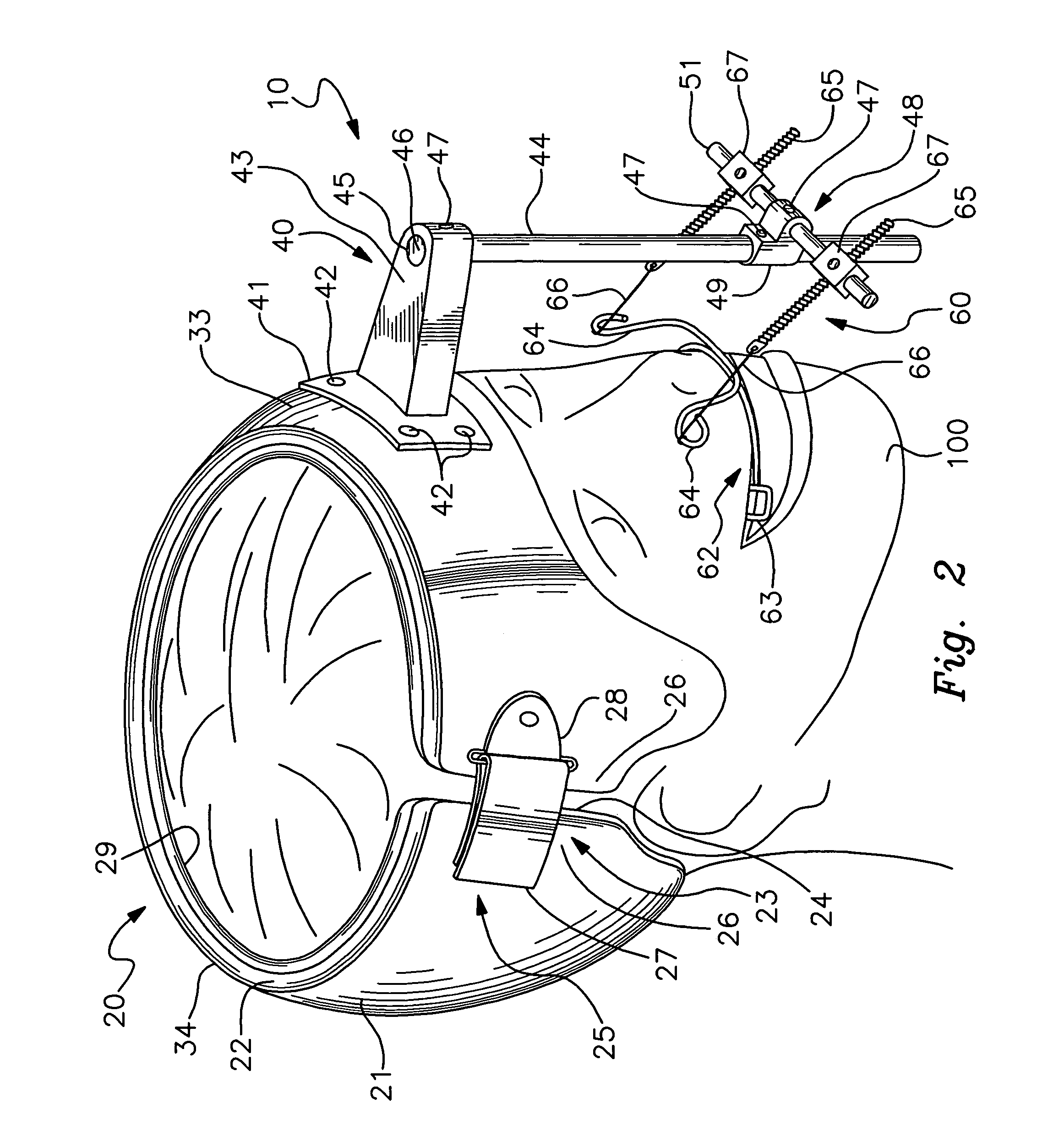 External fixation device for cranialmaxillofacial distraction