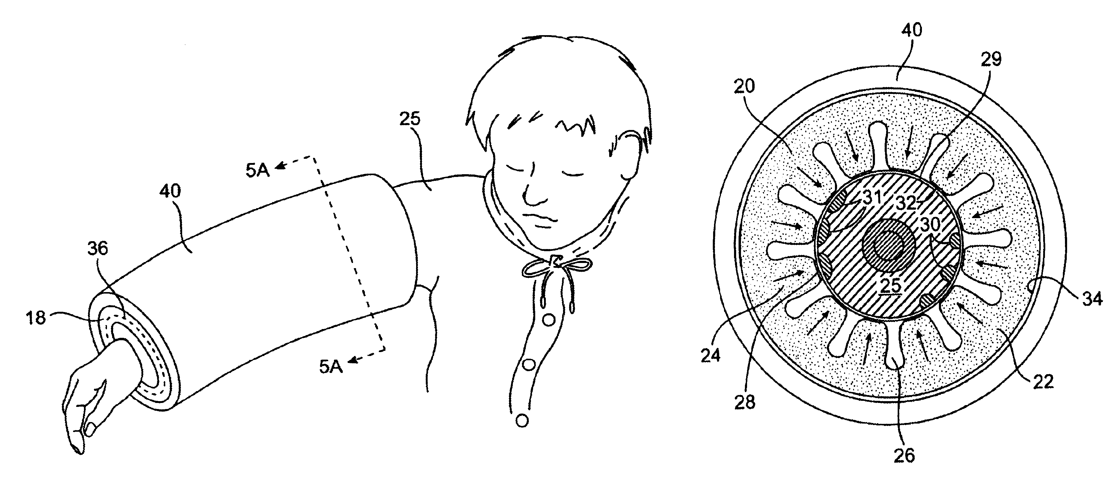 Multiple sleeve method and apparatus for treating edema and other swelling disorders