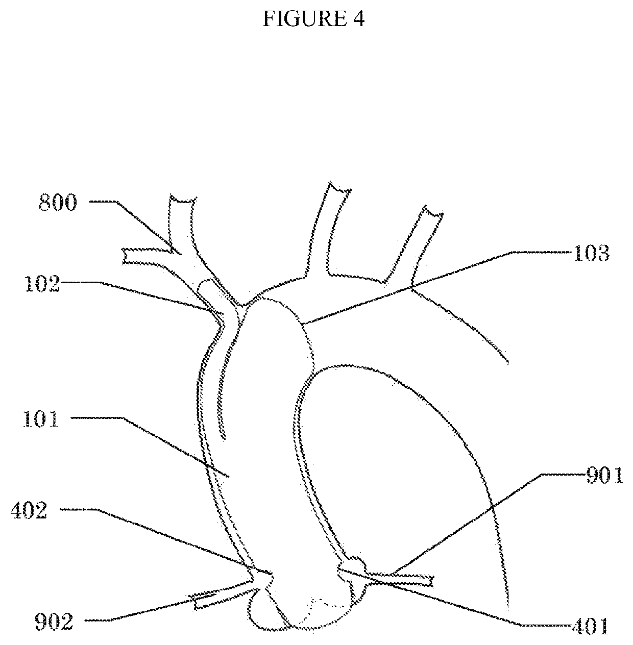 Ascending aortic stent graft