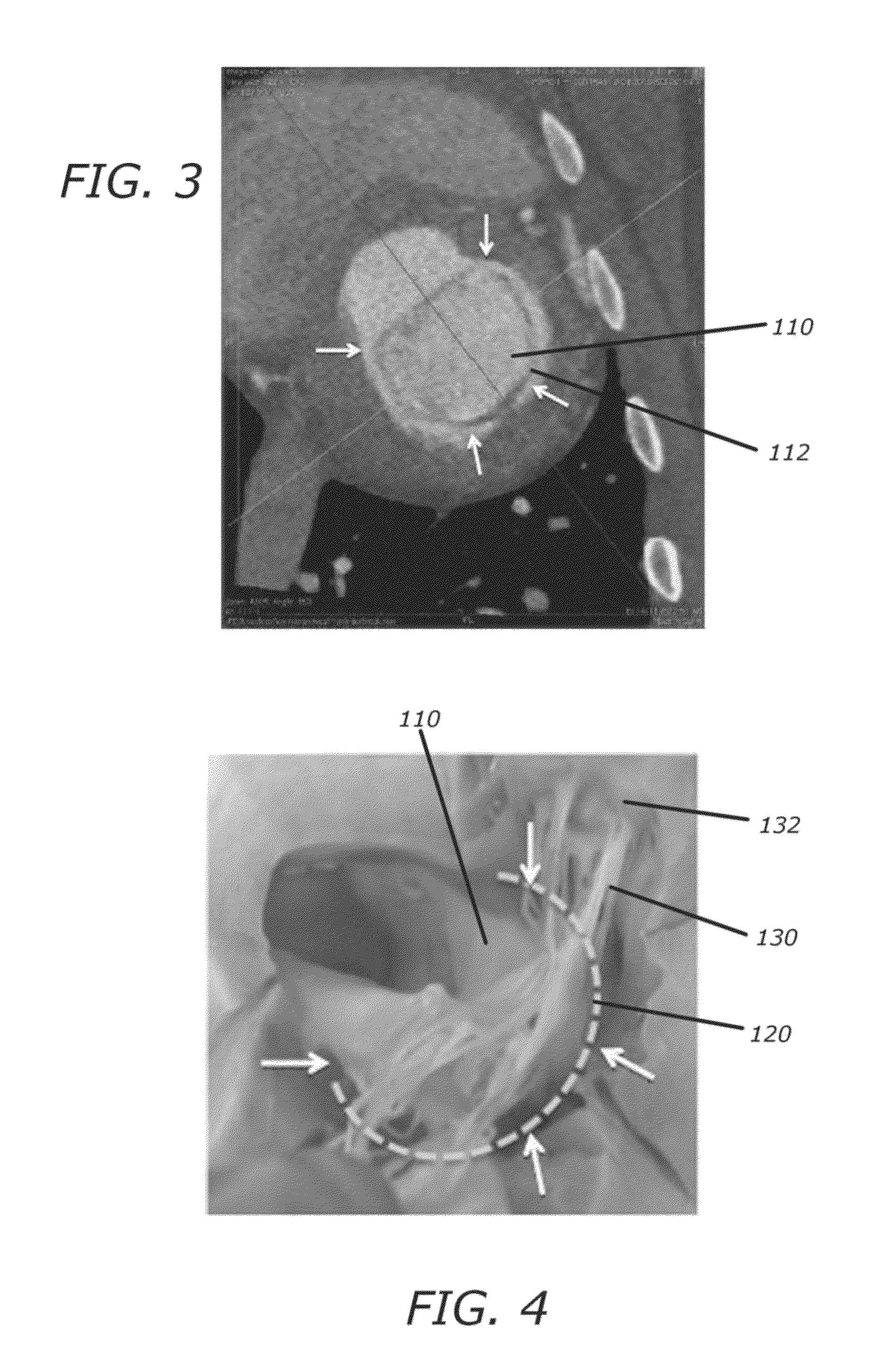 Methods and systems for heart valve therapy