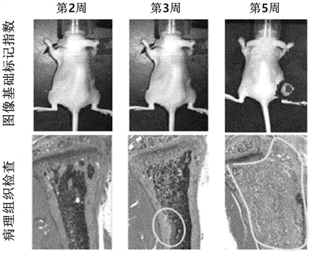 Composition for diagnosis of bone metastasis of cancer and kit comprising same