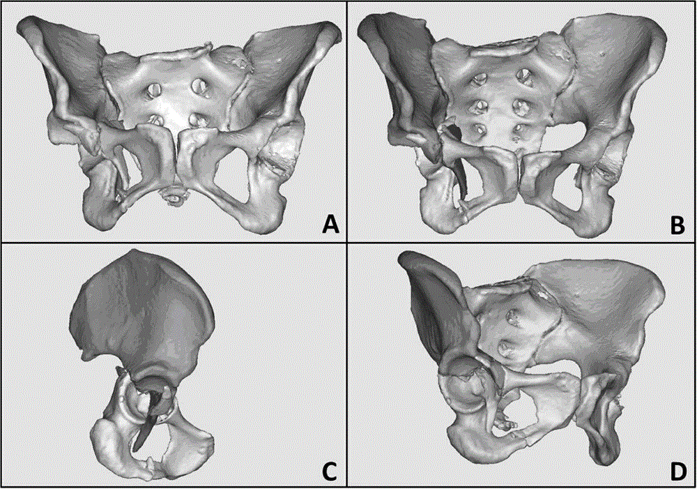 Manufacturing method for posterior column lag screw 3D navigation module used for acetabulum fracture