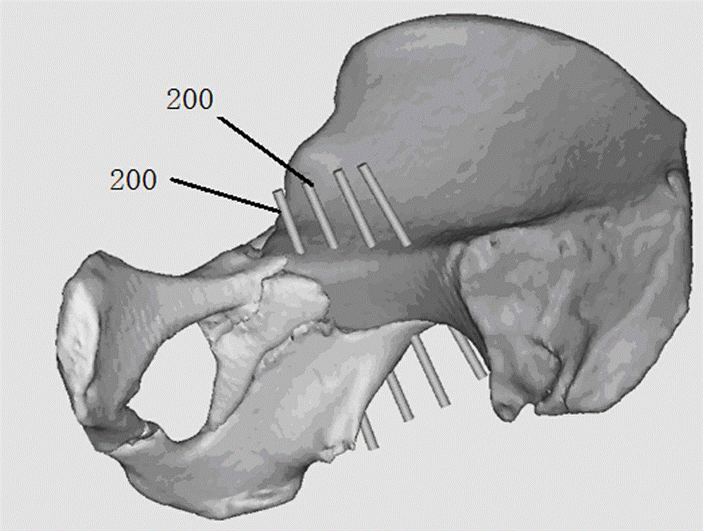 Manufacturing method for posterior column lag screw 3D navigation module used for acetabulum fracture