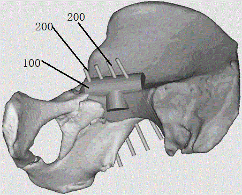 Manufacturing method for posterior column lag screw 3D navigation module used for acetabulum fracture