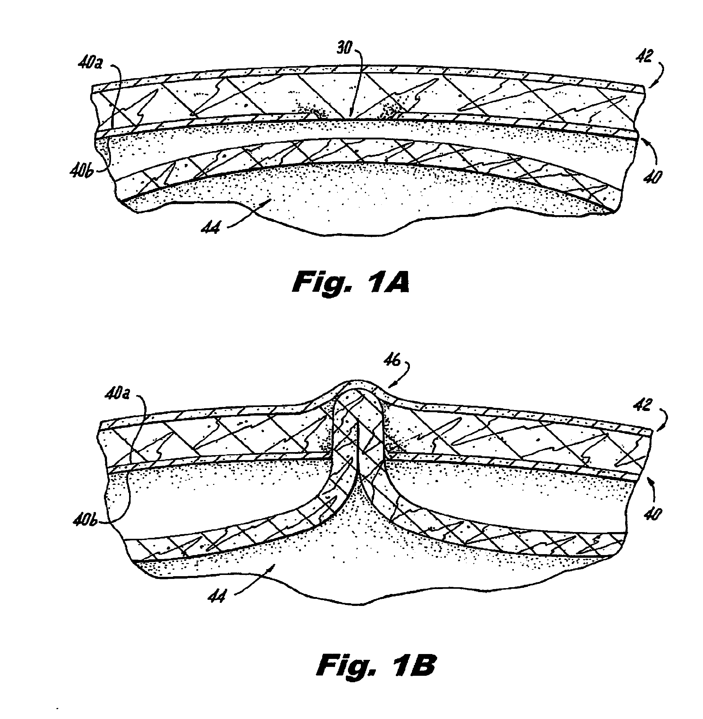 Hernia repair system