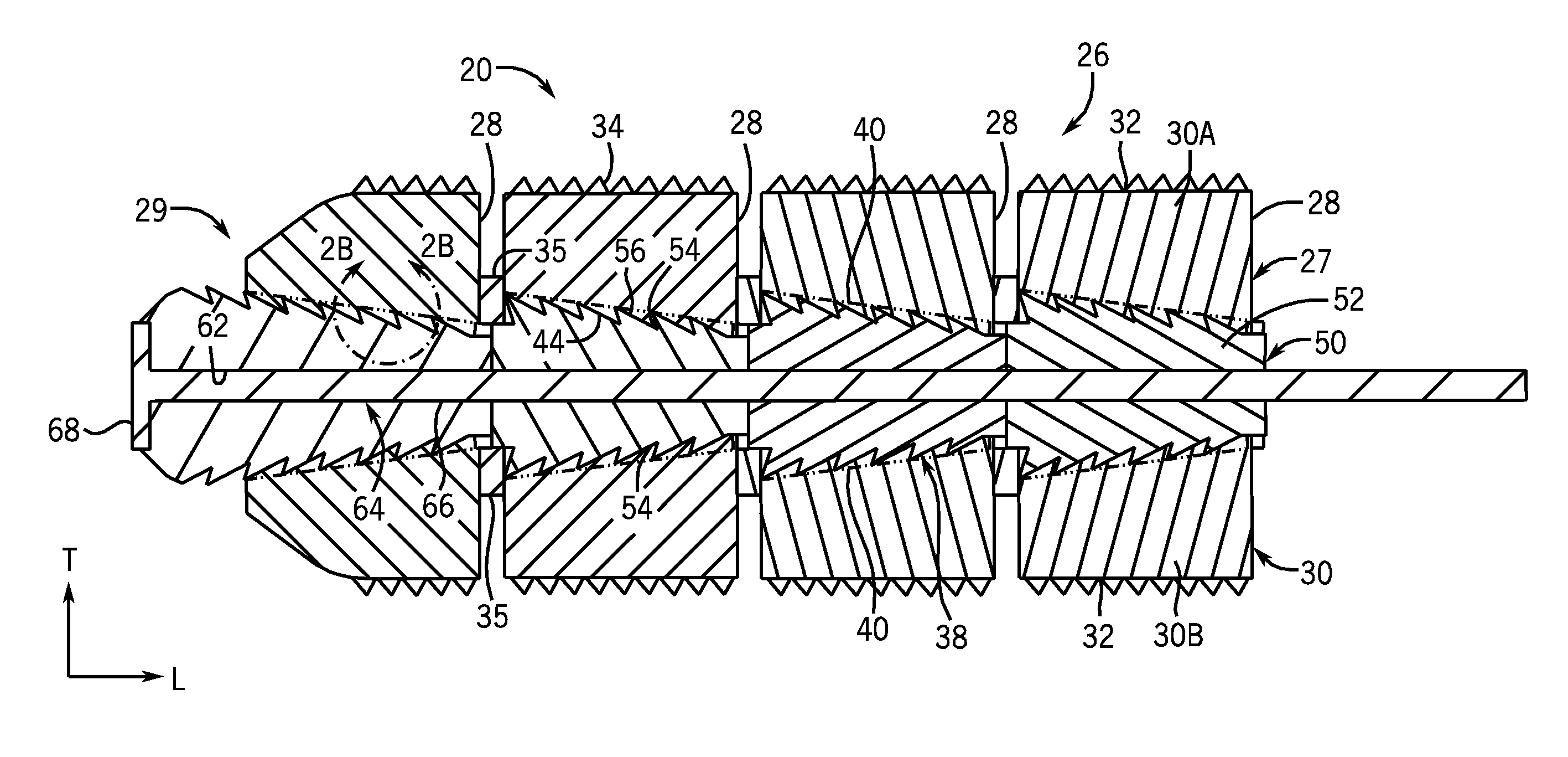 Expandable intervertebral implant