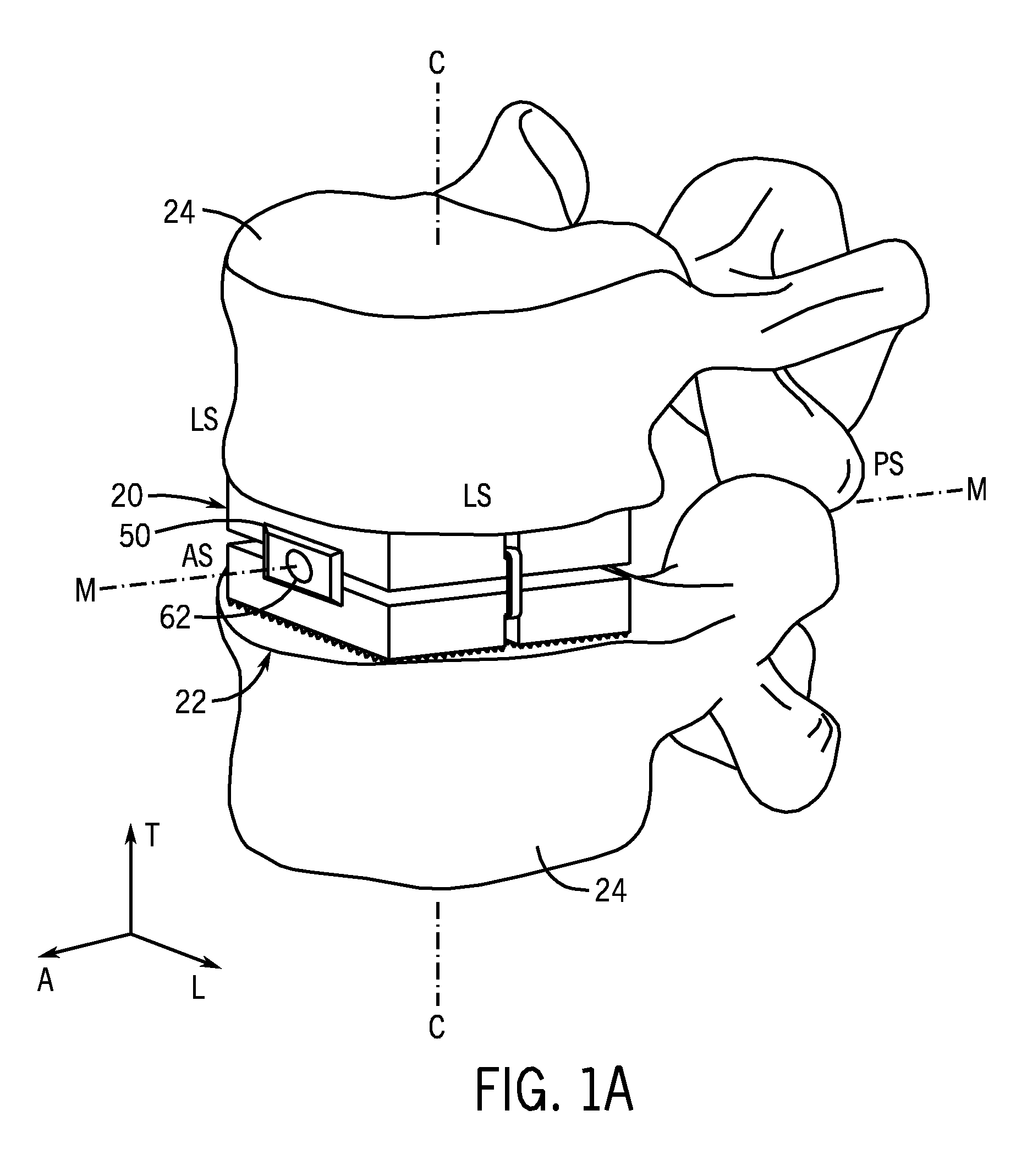 Expandable intervertebral implant