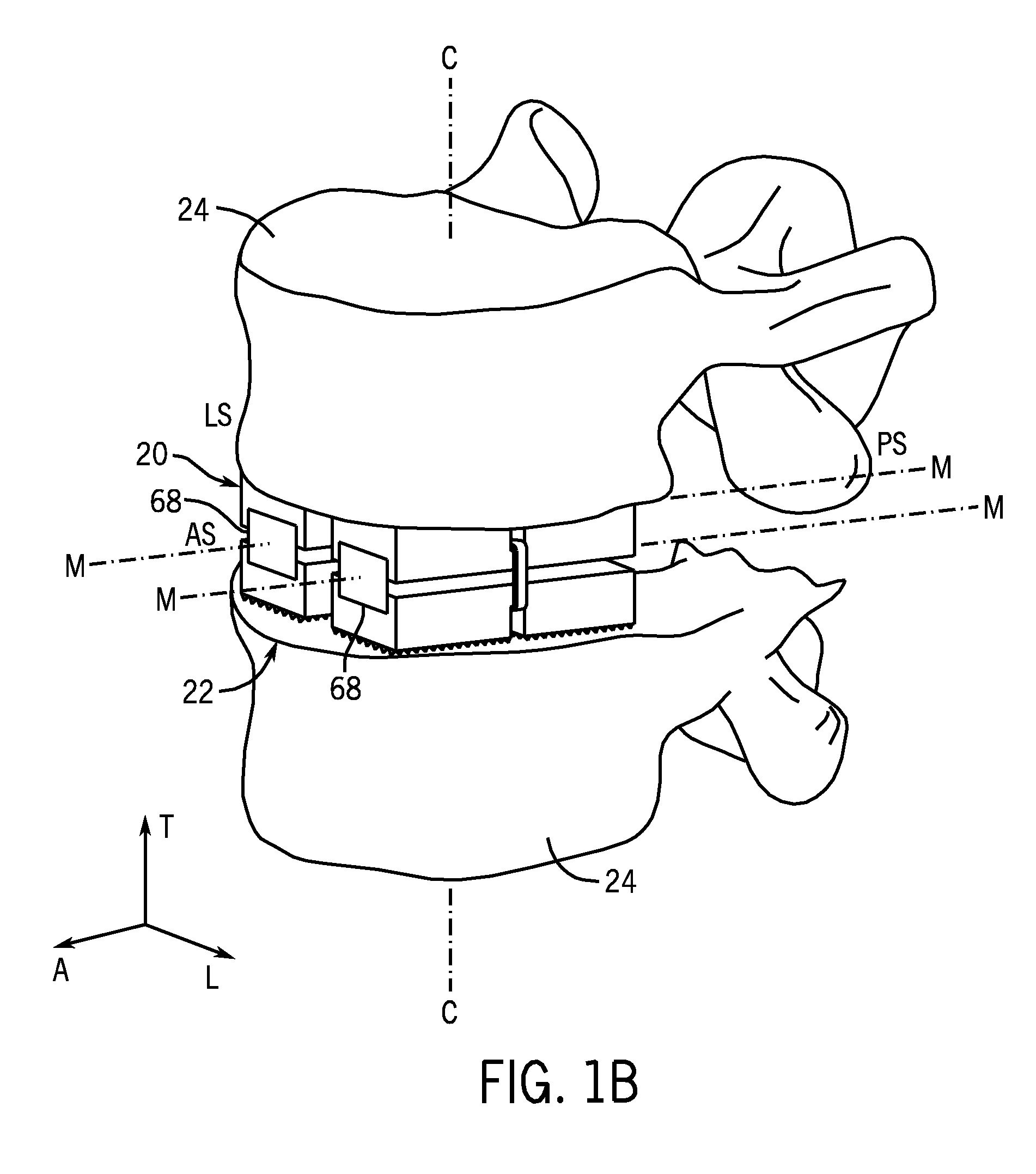 Expandable intervertebral implant