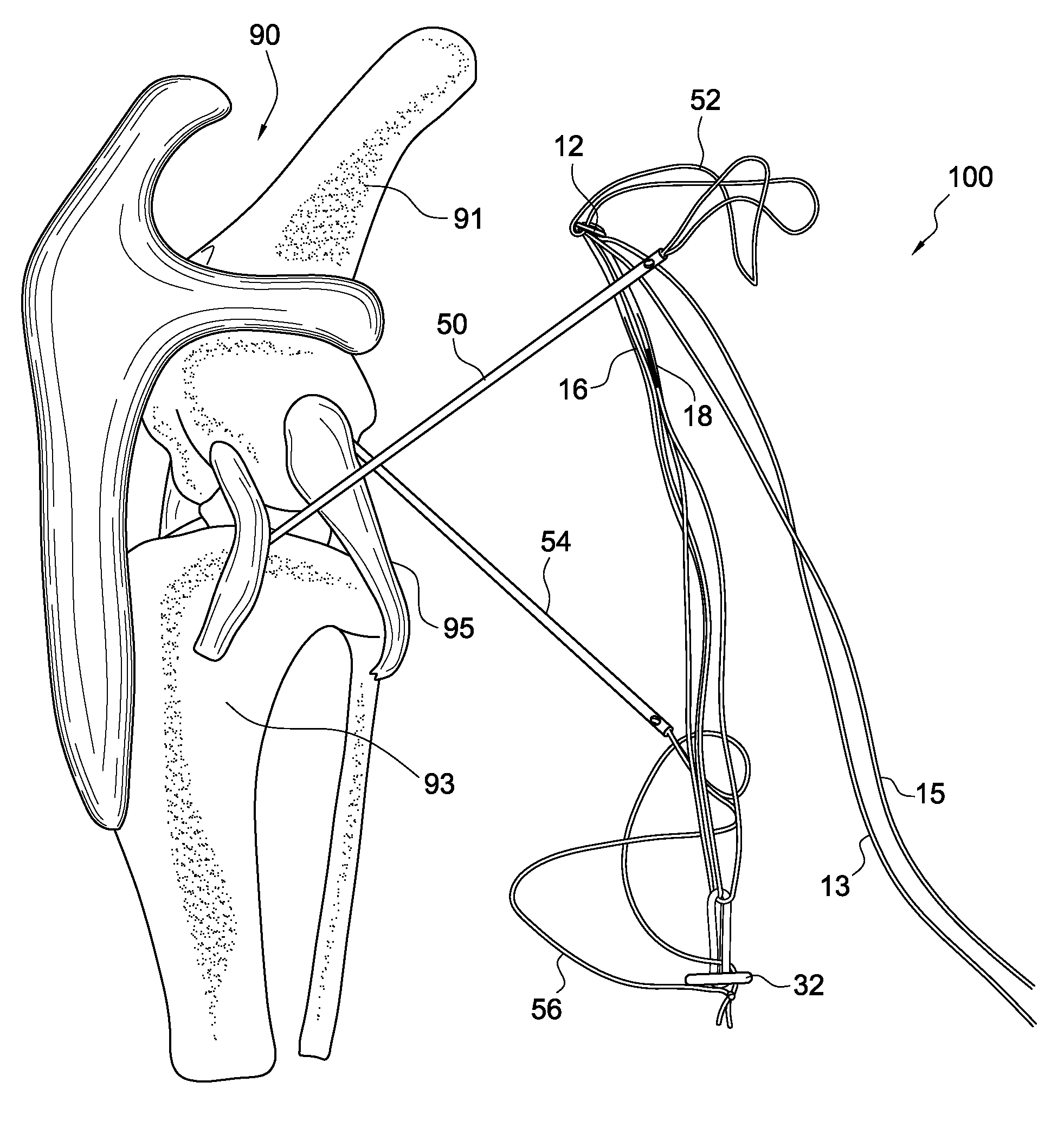 Adjustable suture-button construct for knotless stabilization of cranial cruciate deficient ligament stifle