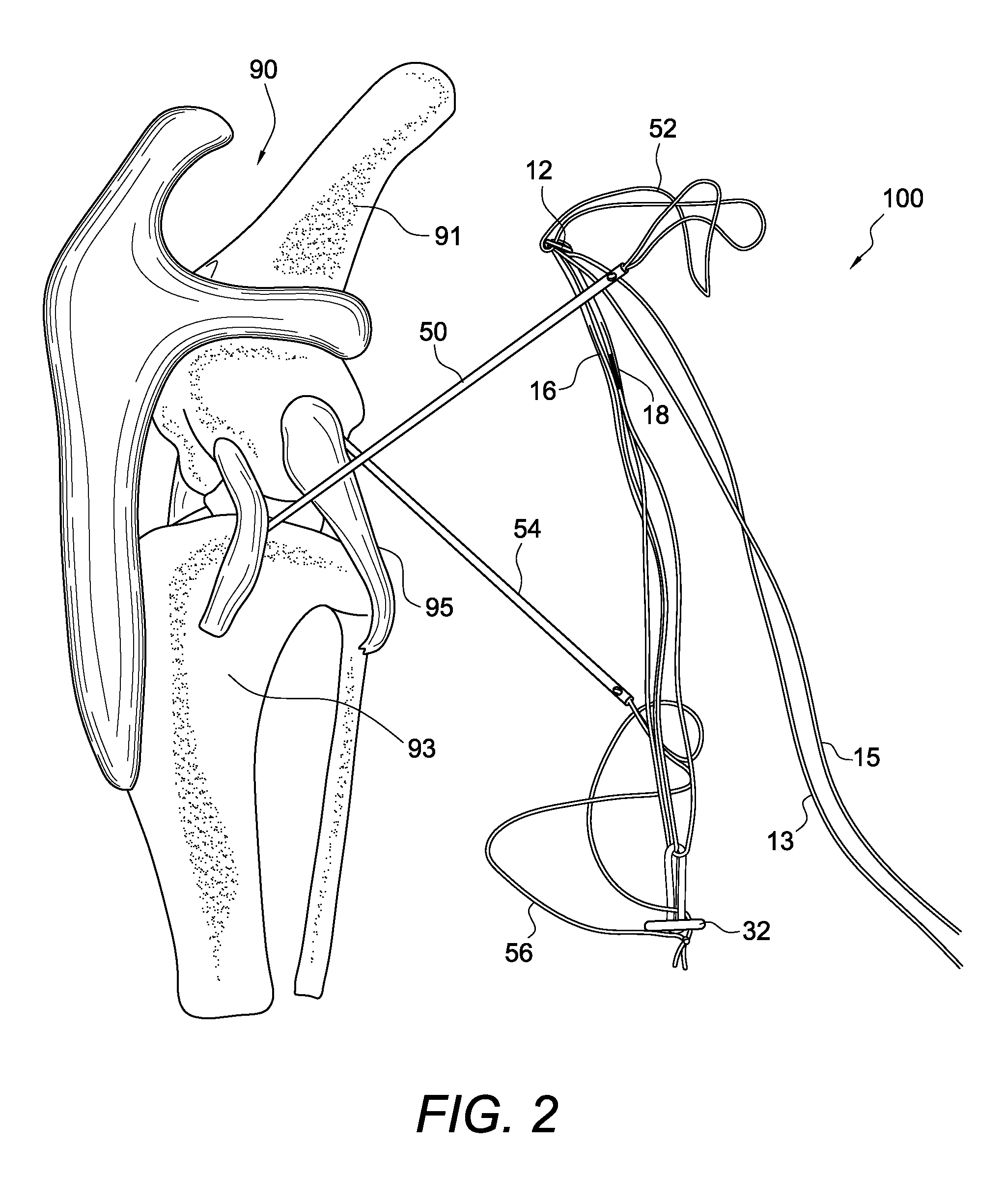 Adjustable suture-button construct for knotless stabilization of cranial cruciate deficient ligament stifle