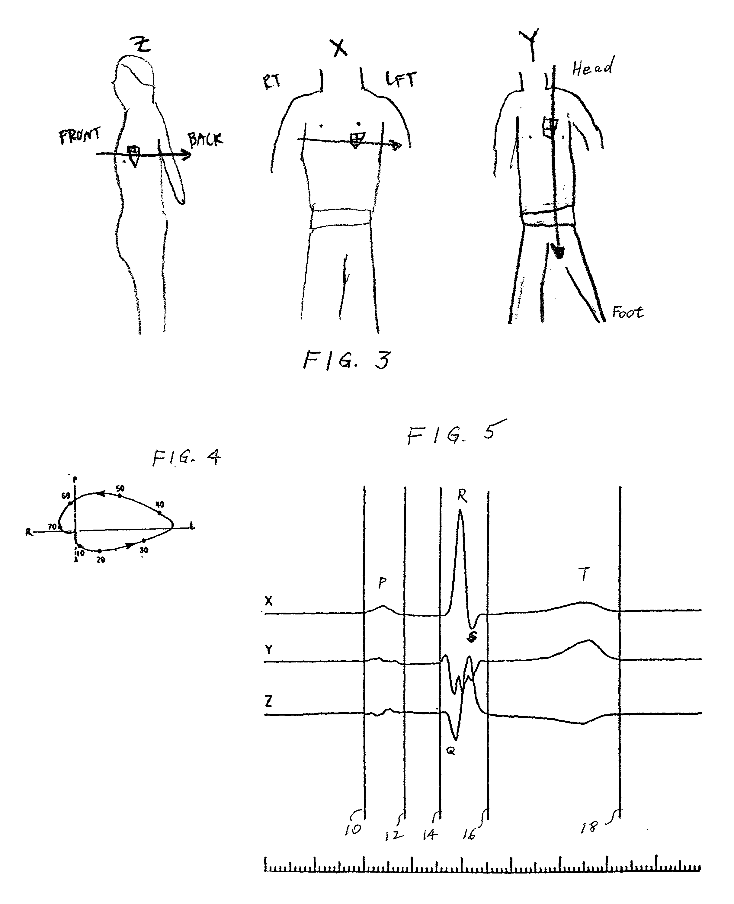 Method of analysis of the electrocardiogram