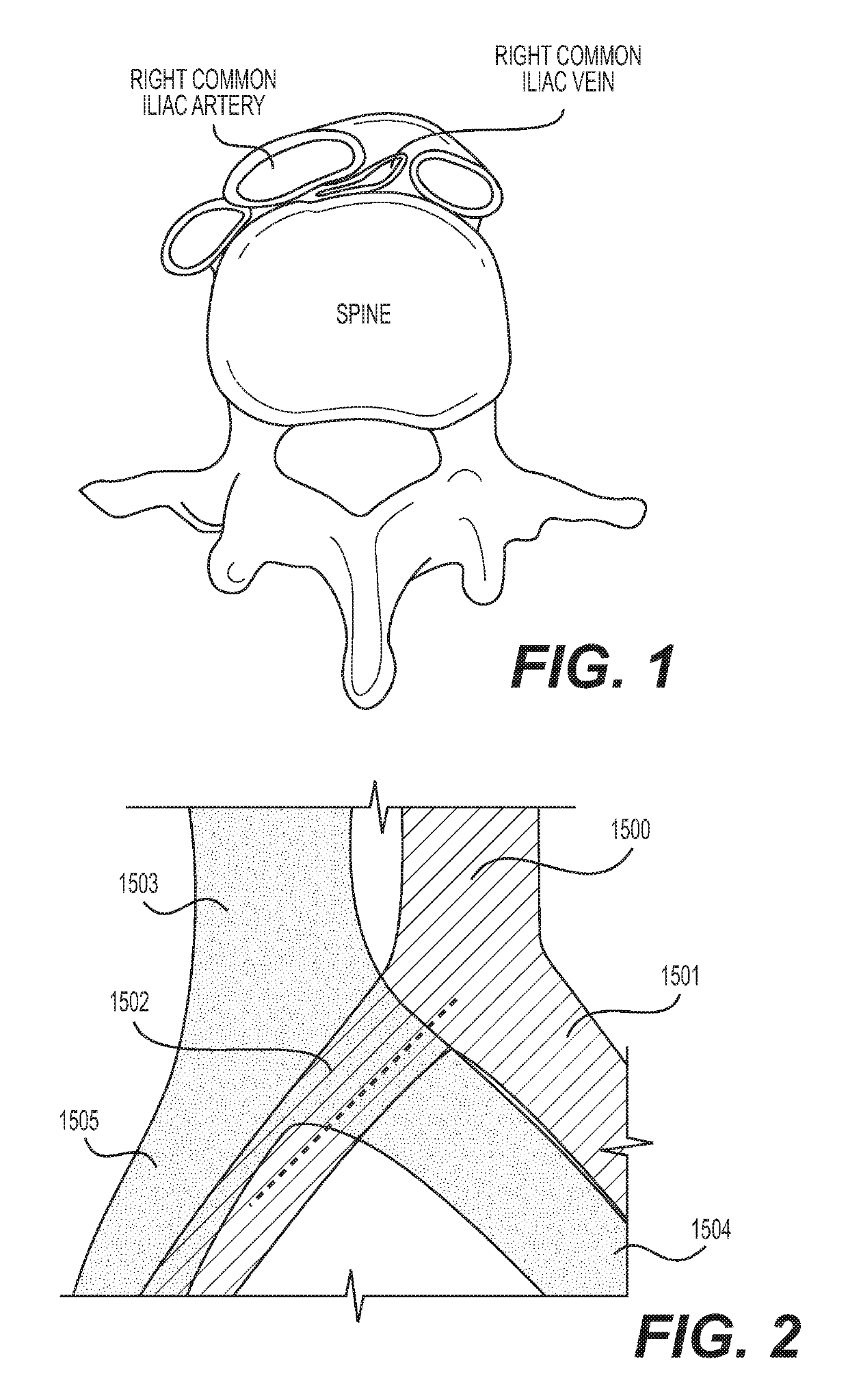 Implantable stent