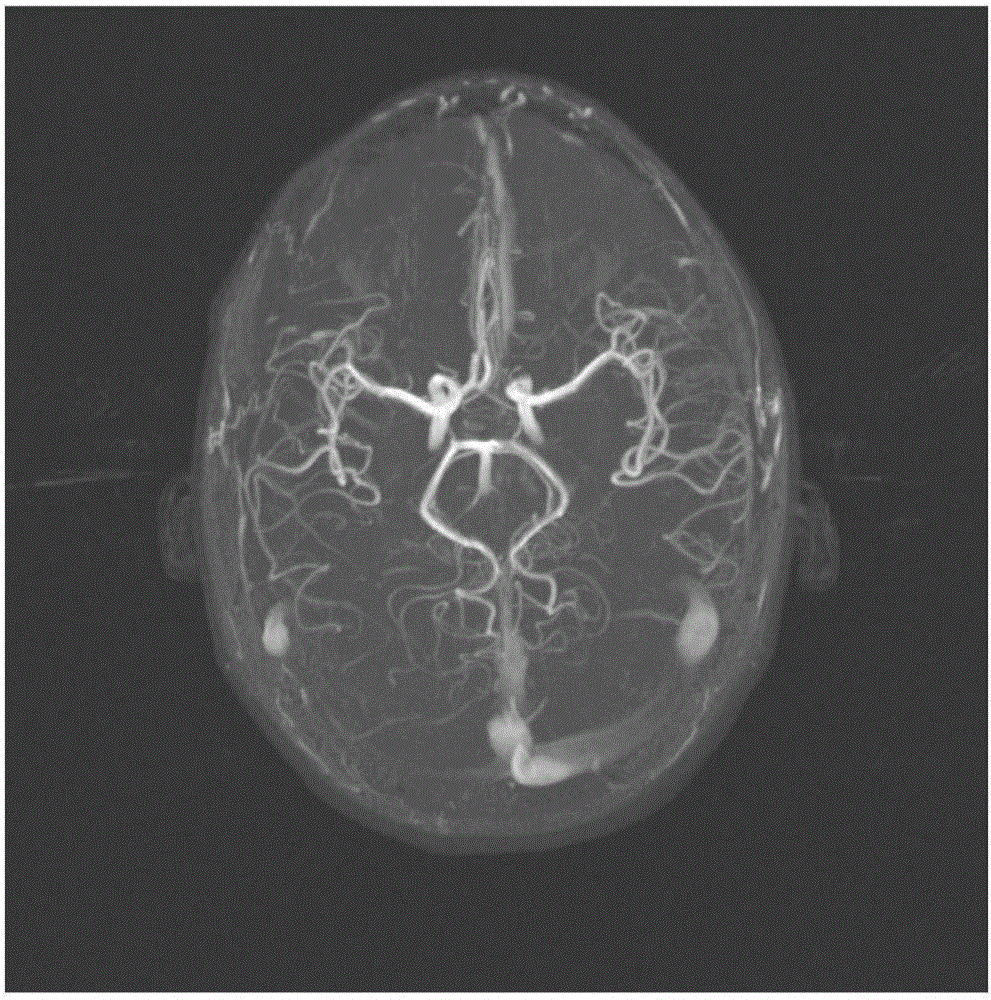 Cerebrovascular quantitative analysis method based on skeleton line