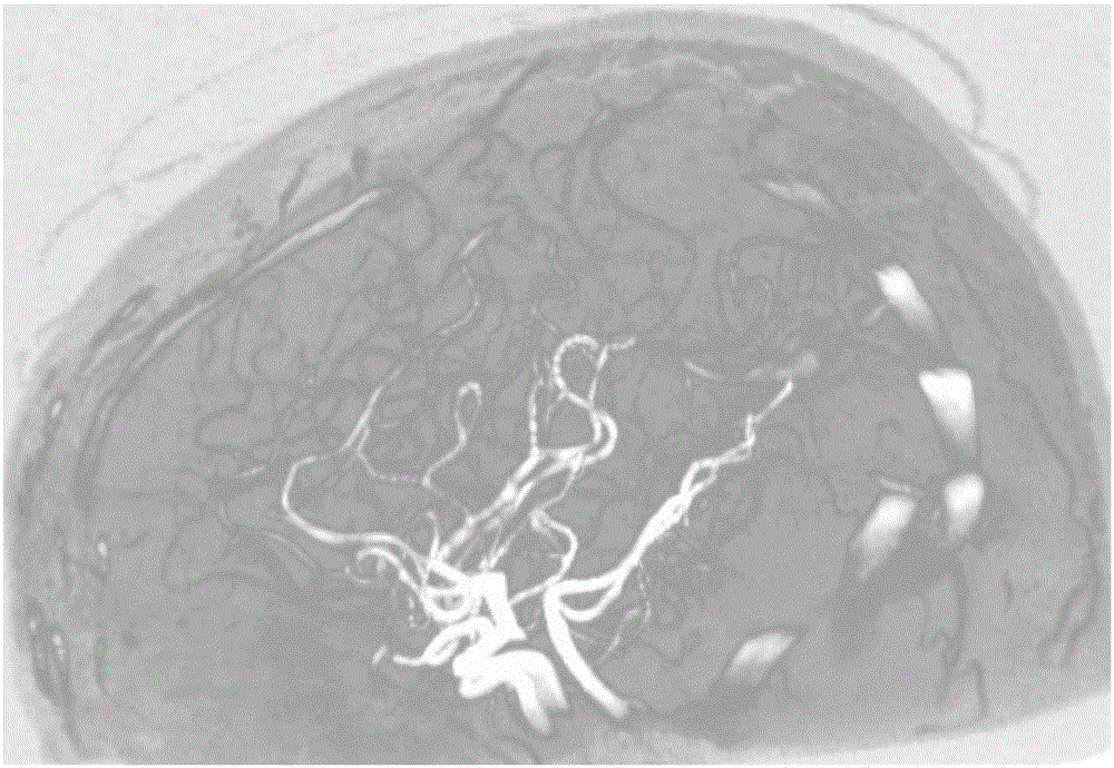 Cerebrovascular quantitative analysis method based on skeleton line