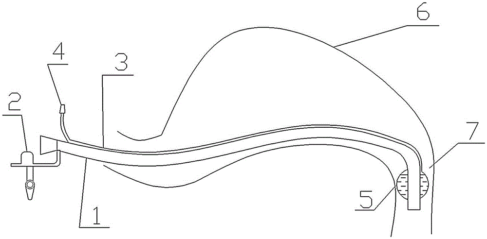 Jejunum nutrient canal with water bag