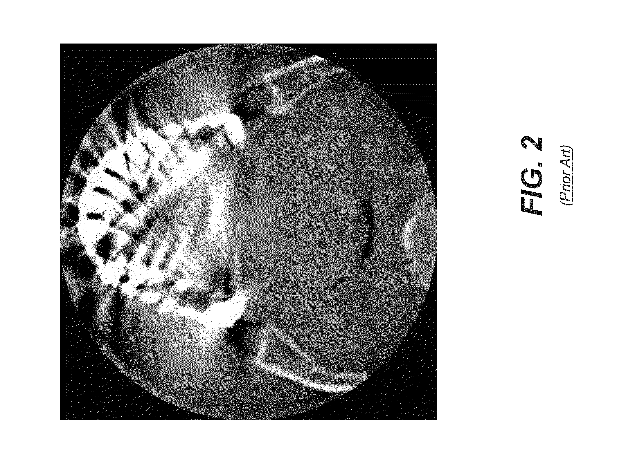 Metal artifacts reduction in cone beam reconstruction