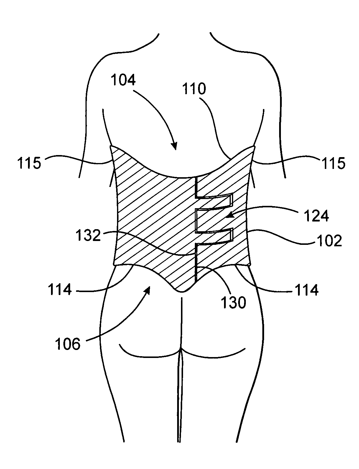 Post operative pressure garment