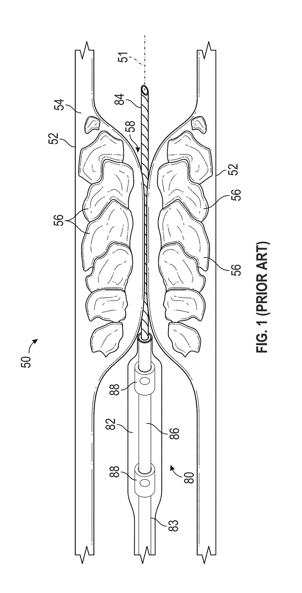 Shock wave balloon catheter with insertable electrodes