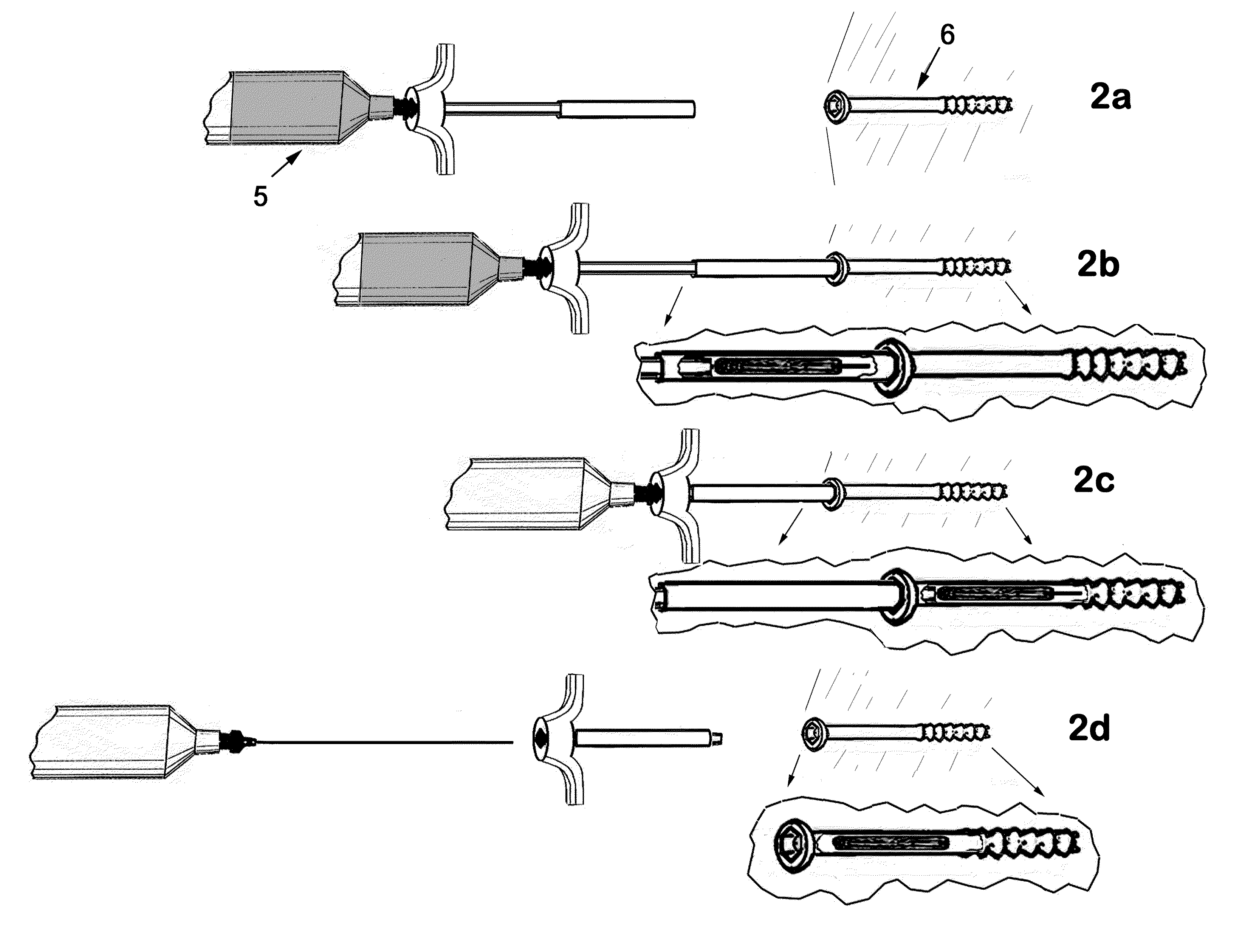 Therapeutic material delivery system for tissue voids and cannulated implants