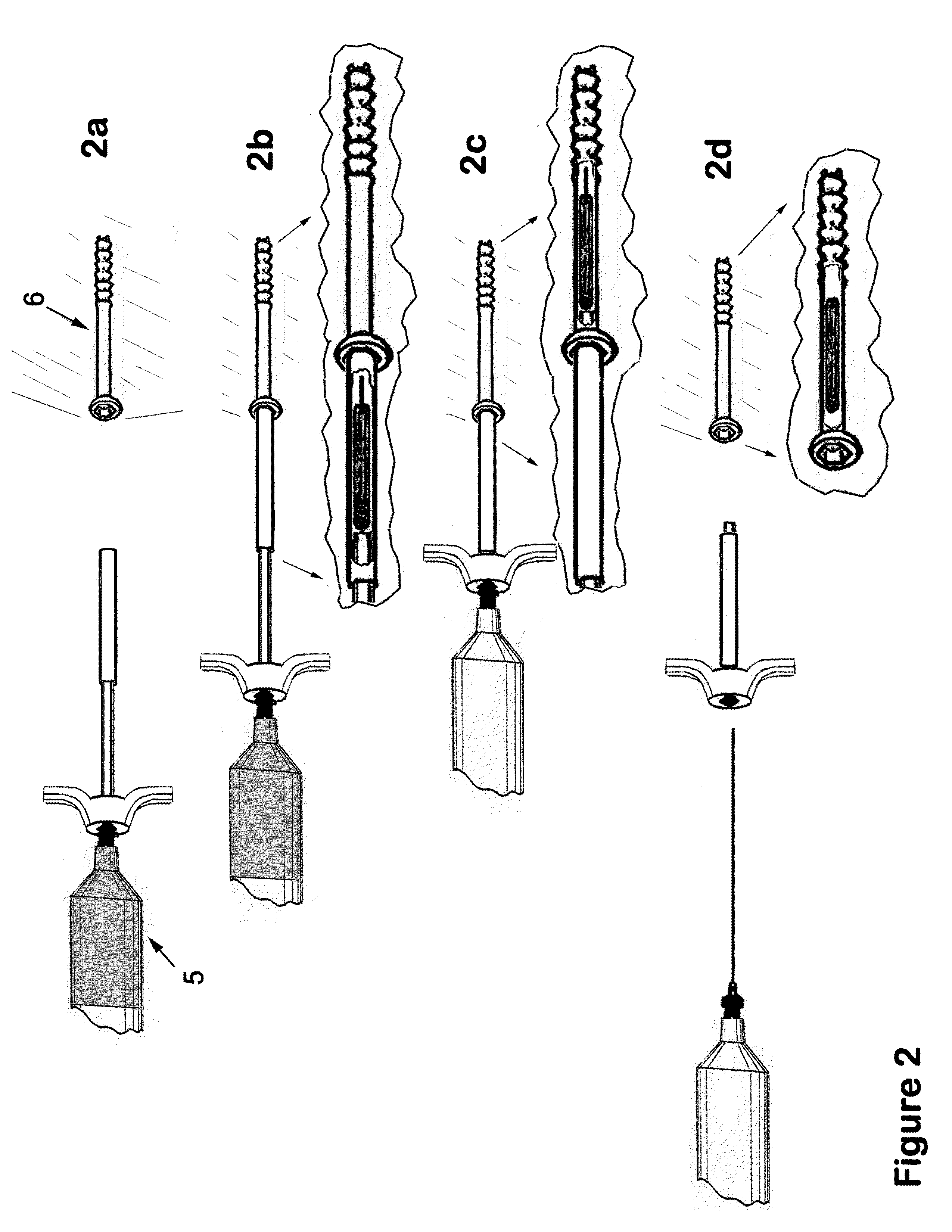 Therapeutic material delivery system for tissue voids and cannulated implants