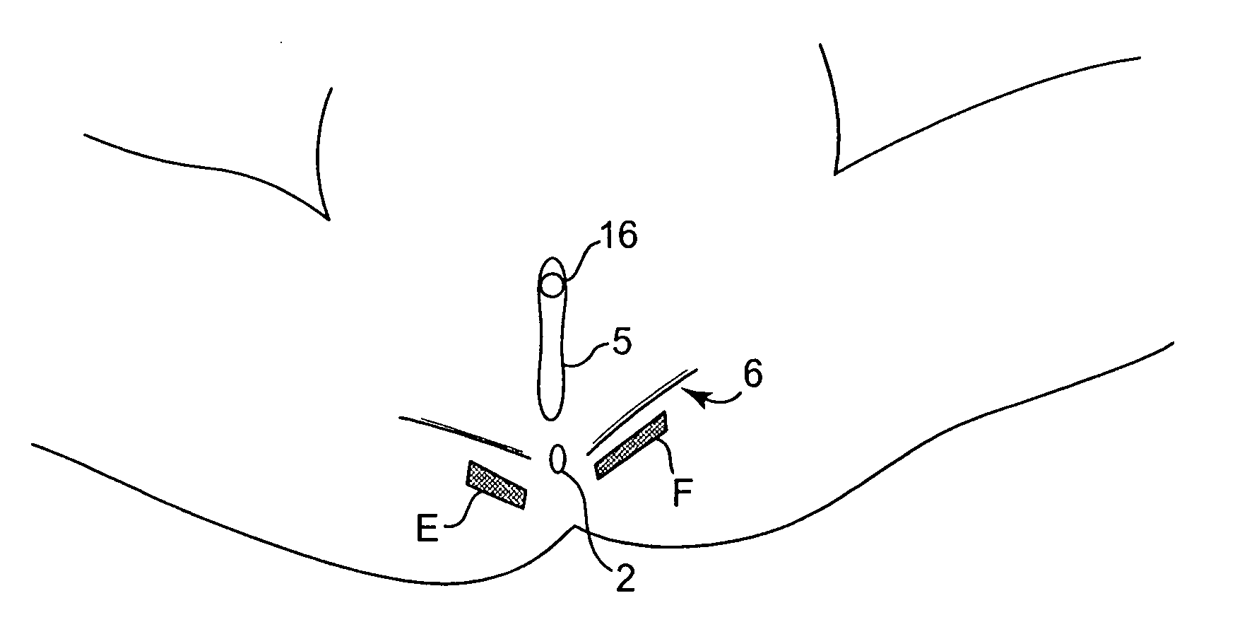 Floating Sling for Treatment of Incontinence