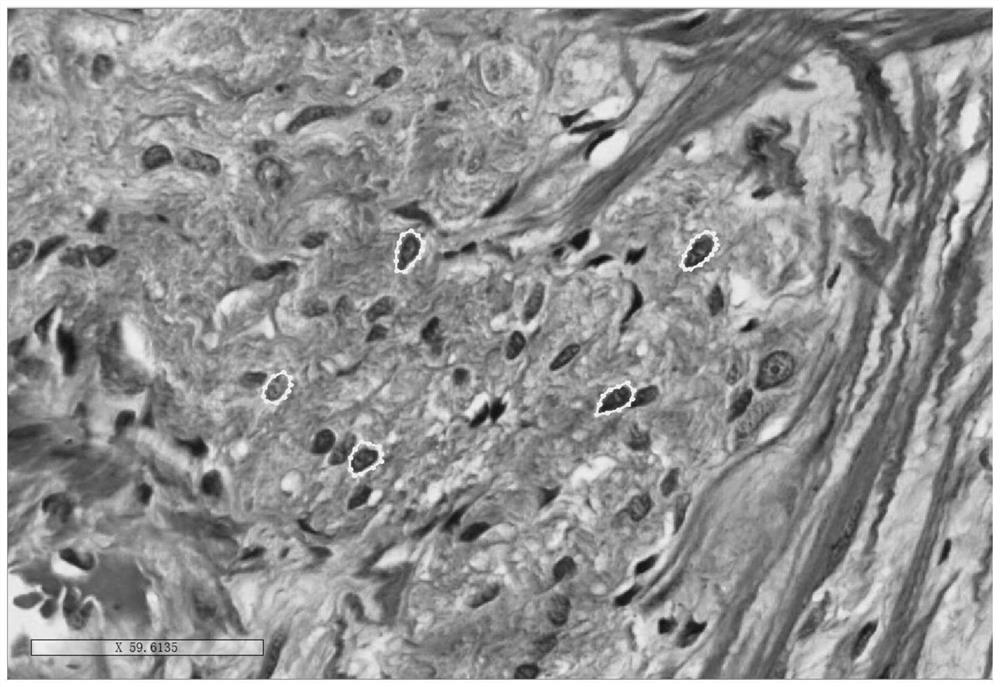 Intestinal neuron neuron dysplasia recognition method based on Swinin-Unet algorithm