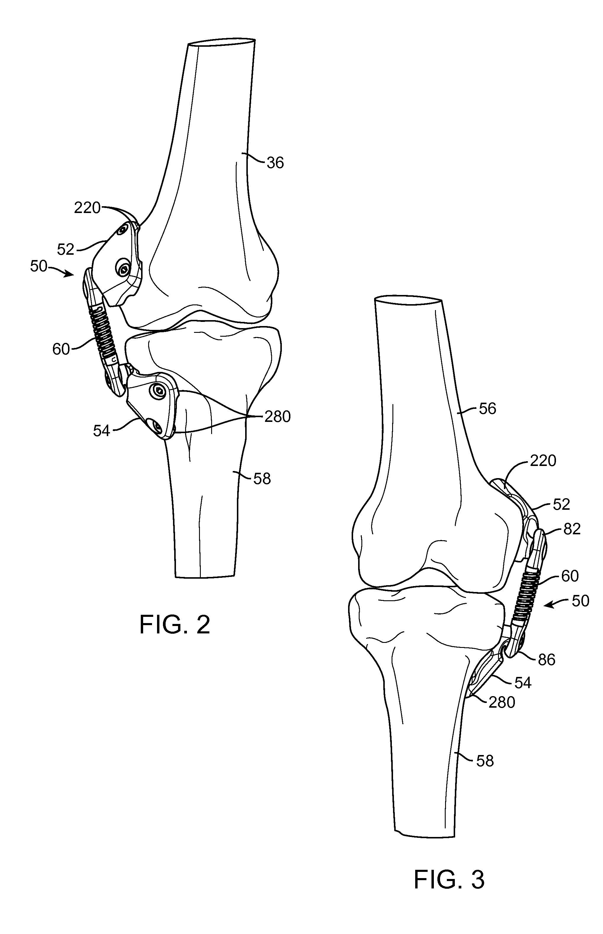 Implantation Approach and Instrumentality for an Energy Absorbing System