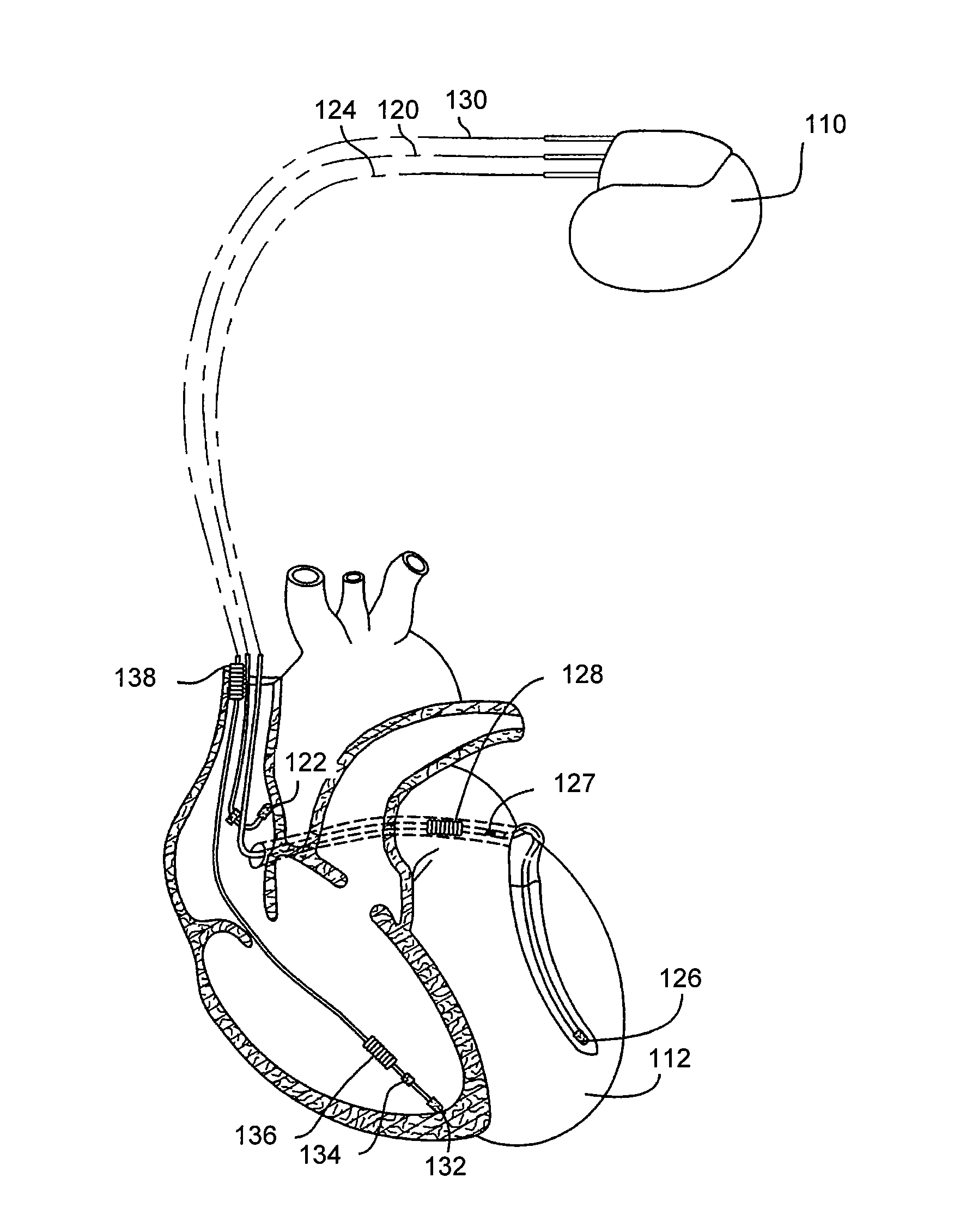 Methods and systems to monitor venous blood oxygen saturation