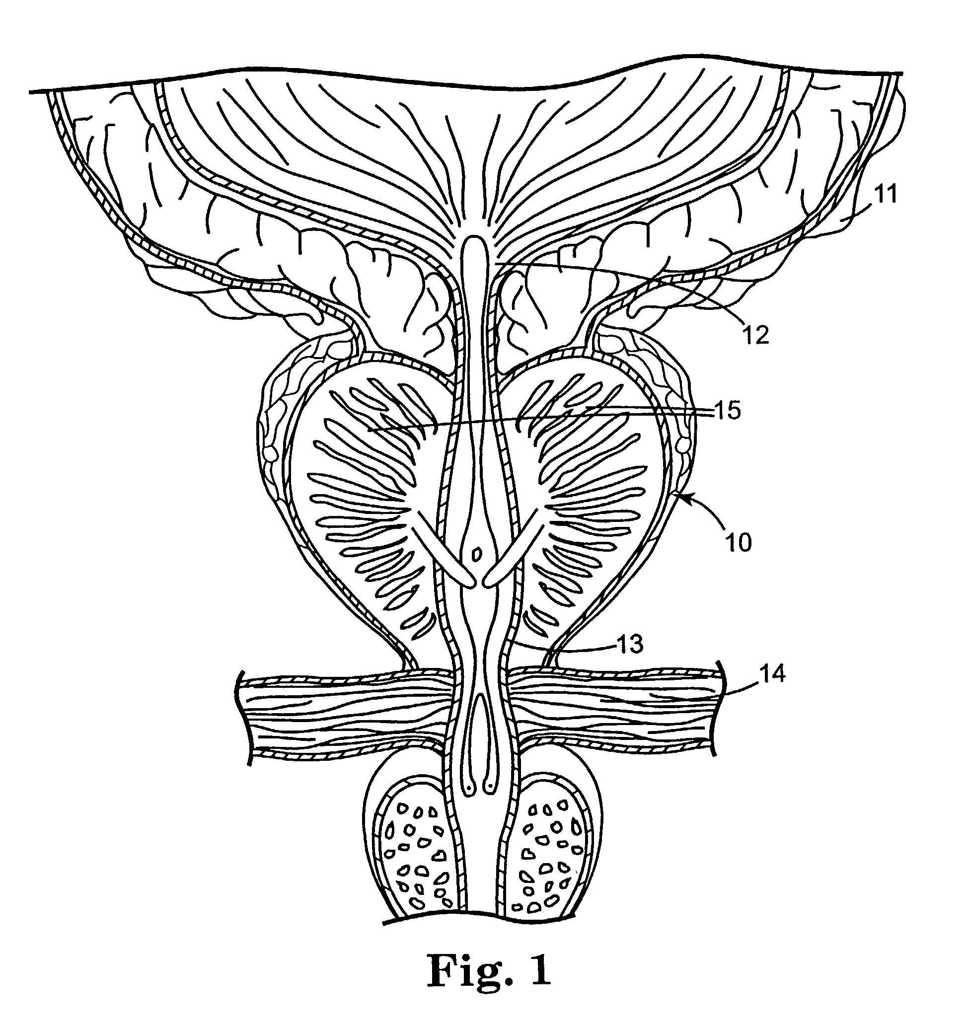 Regimen for treating prostate tissue and surgical kit for use in the regimen