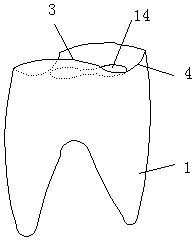 Dental implant for double tooth roots and implant tooth