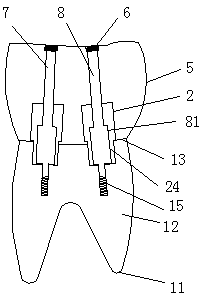 Dental implant for double tooth roots and implant tooth