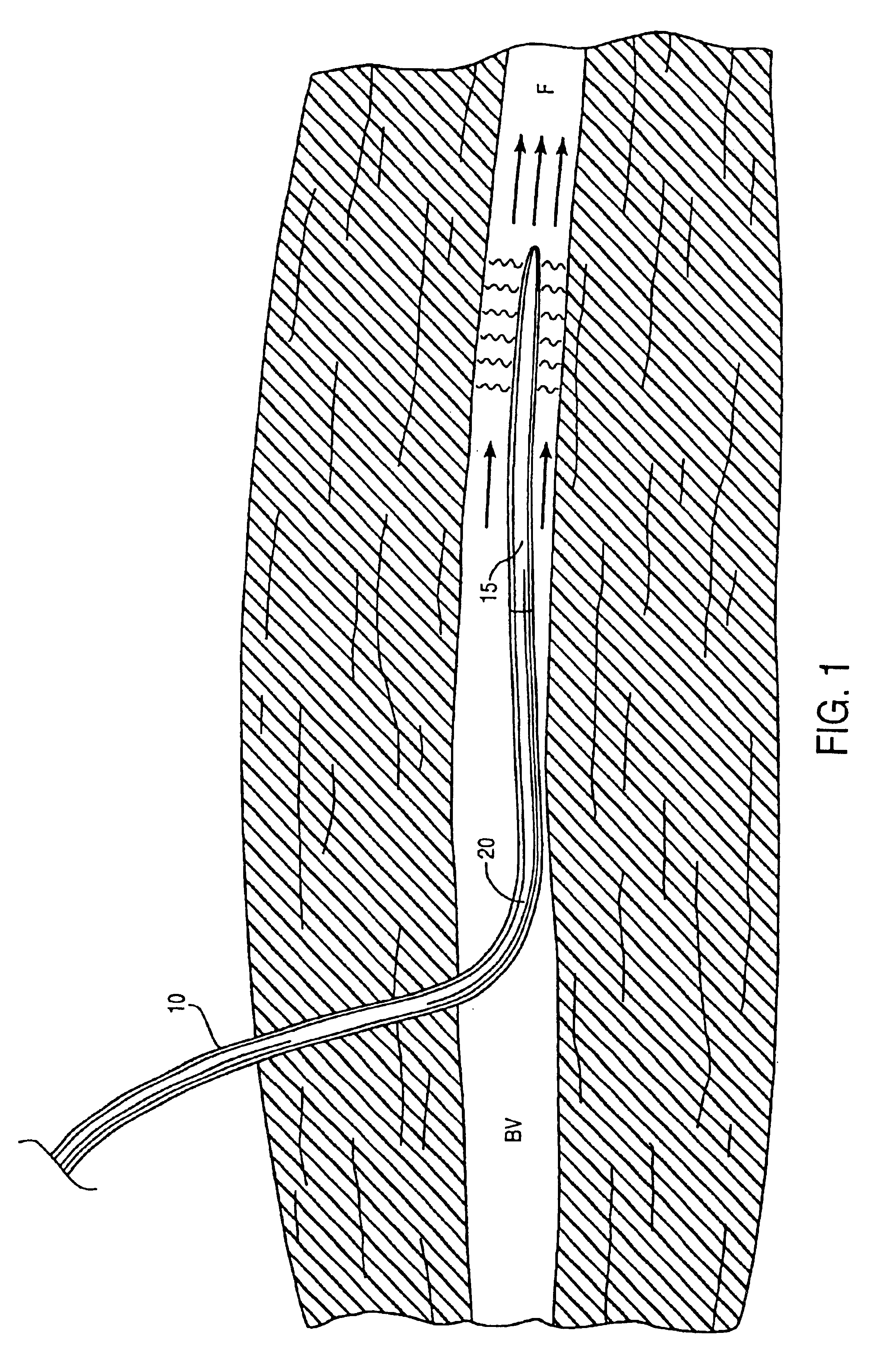 Method and apparatus for controlling a patients's body temperature by in situ blood temperature modification