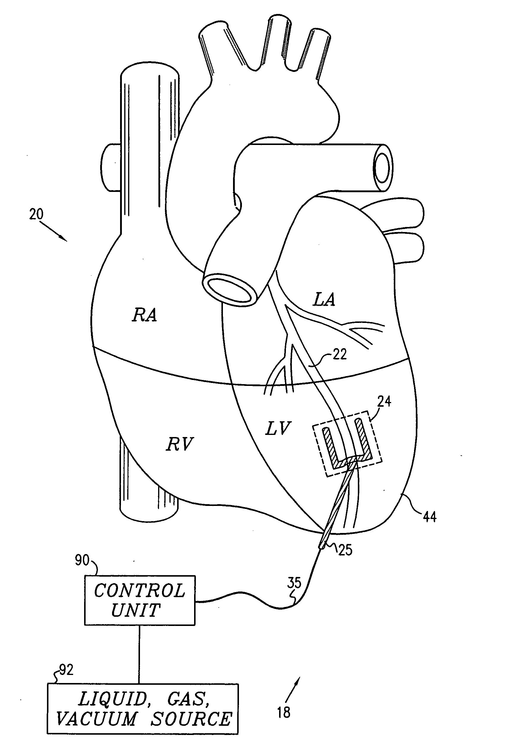 Local cardiac motion control using applied signals and mechanical force