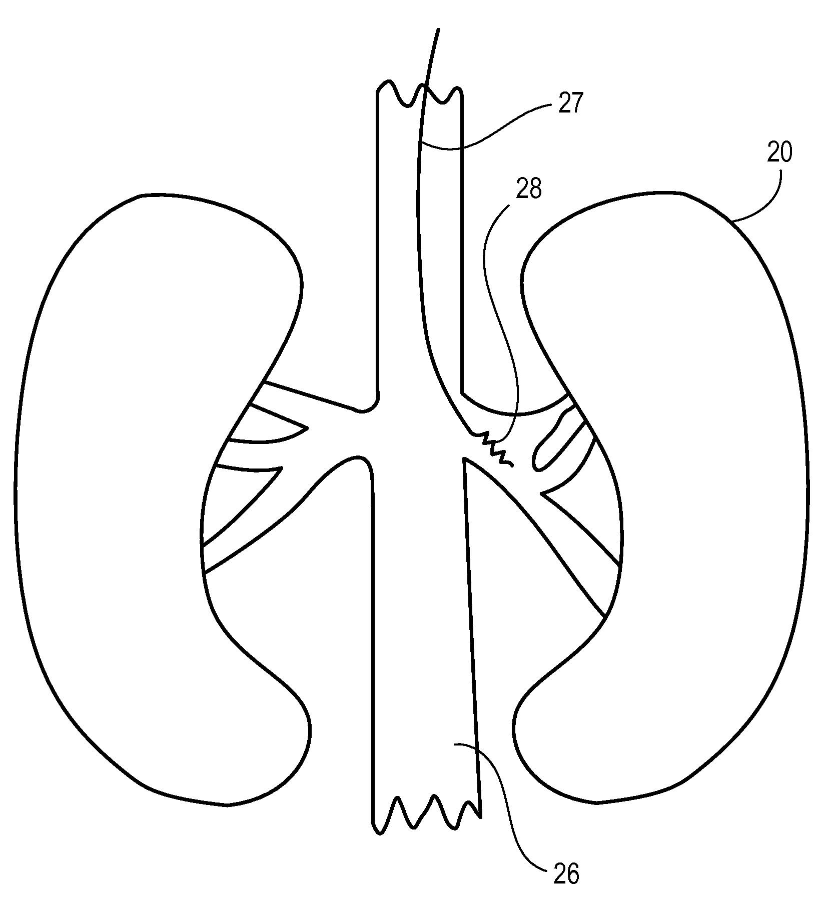 Methods and materials for treating syncope