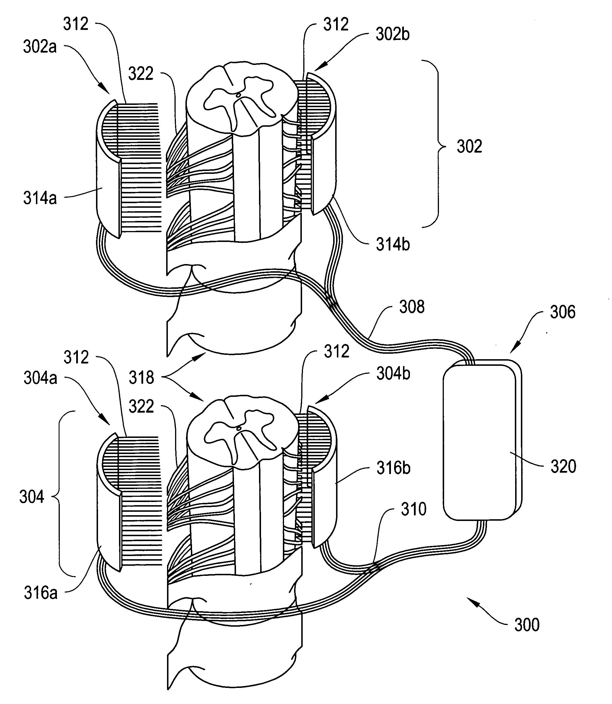 Spinal cord implant systems and methods