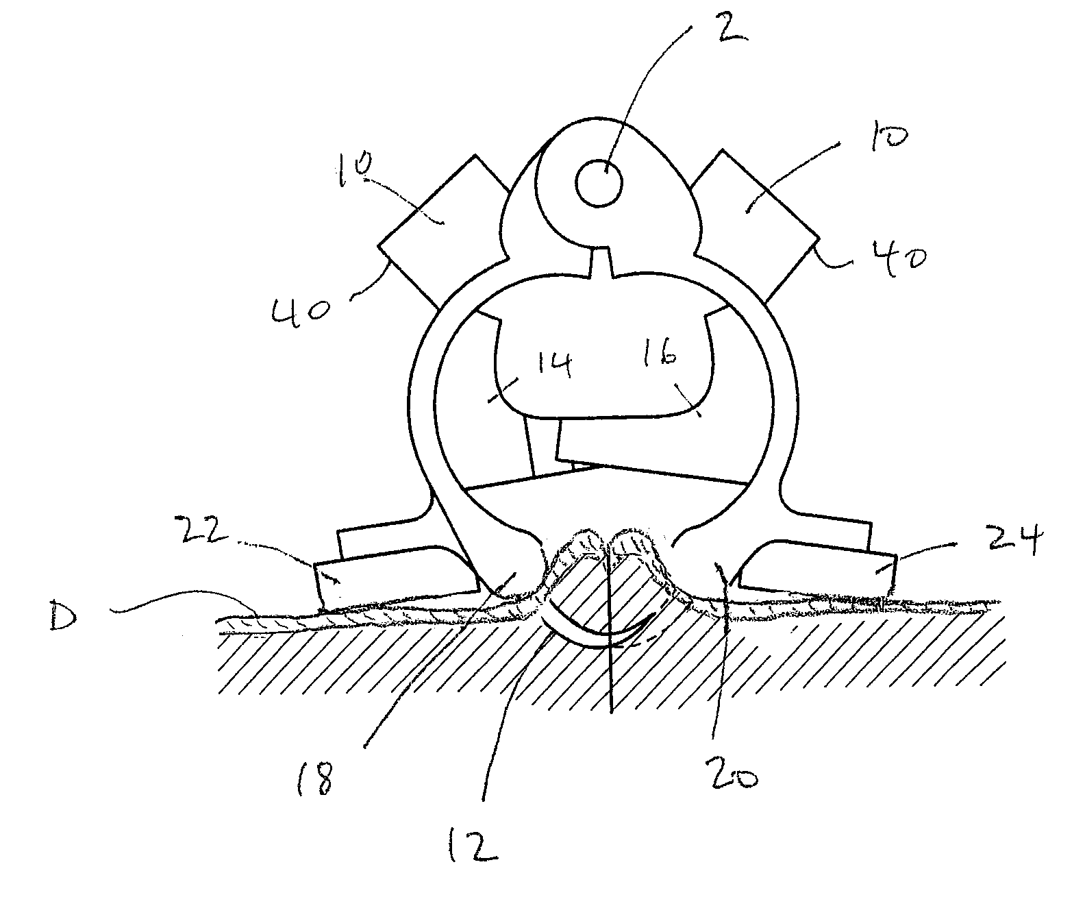 Wound clamp