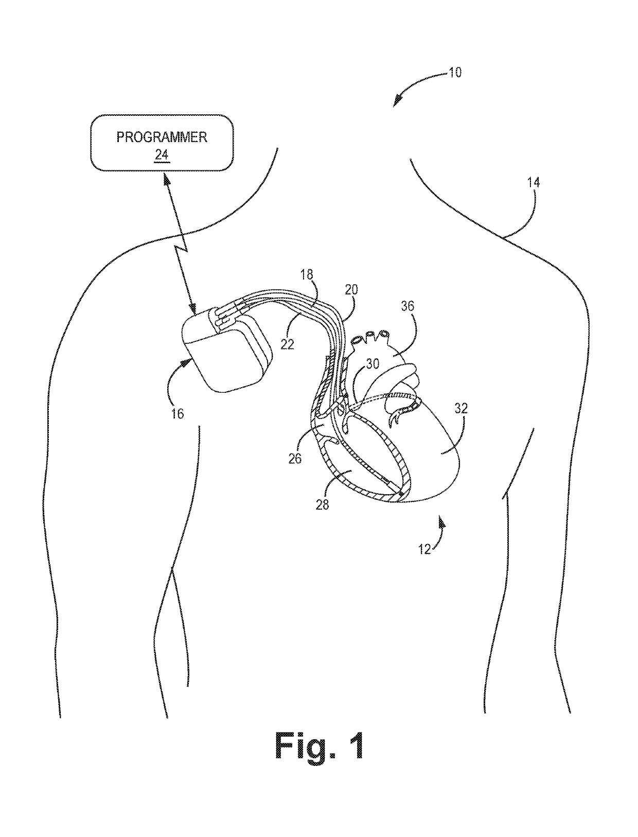 Absolute intrathoracic impedance based scheme to stratify patients for risk of a heart failure event