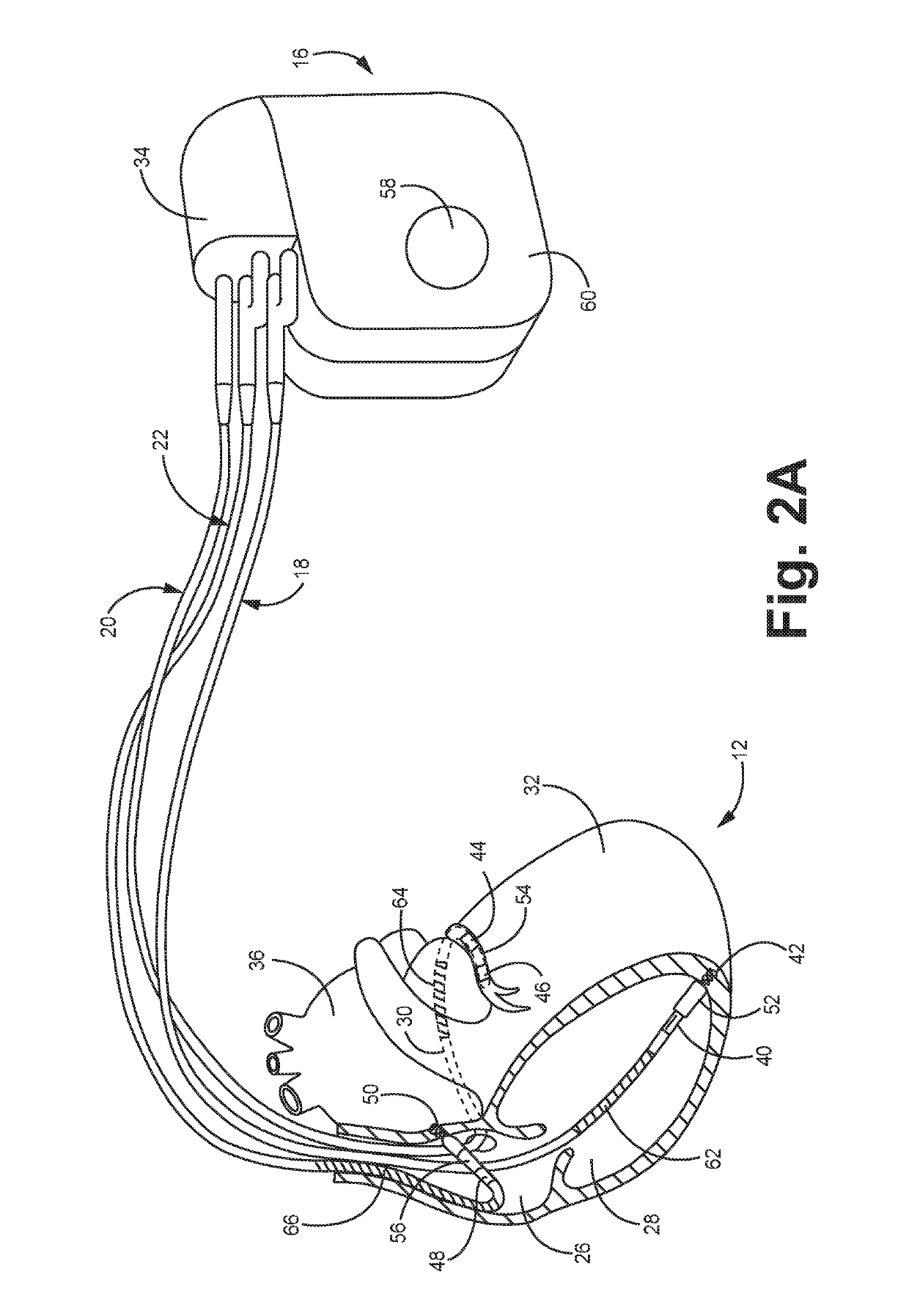 Absolute intrathoracic impedance based scheme to stratify patients for risk of a heart failure event