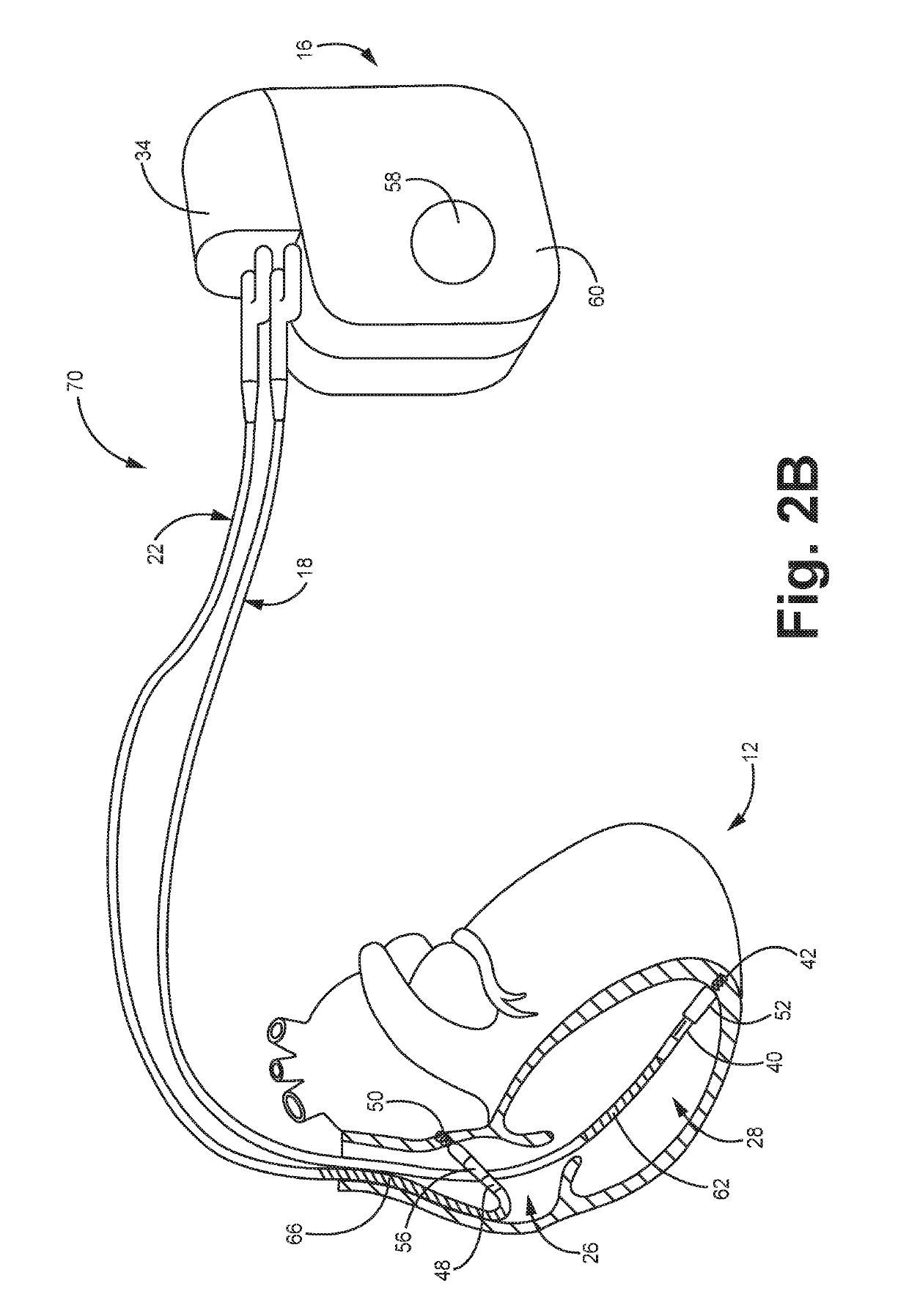 Absolute intrathoracic impedance based scheme to stratify patients for risk of a heart failure event