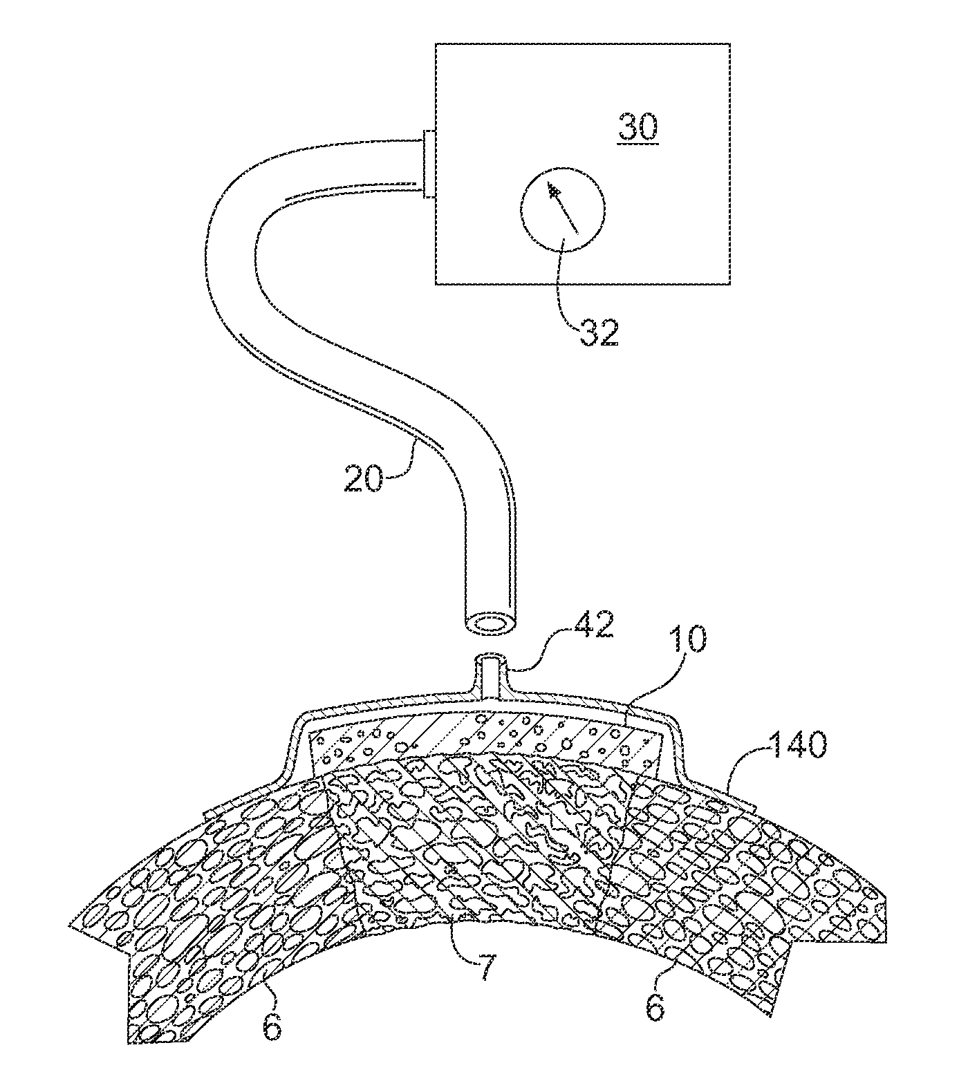 Apparatus and Method for Cardiac Tissue Modulation by Topical Application of Vacuum to Minimize Cell Death and Damage