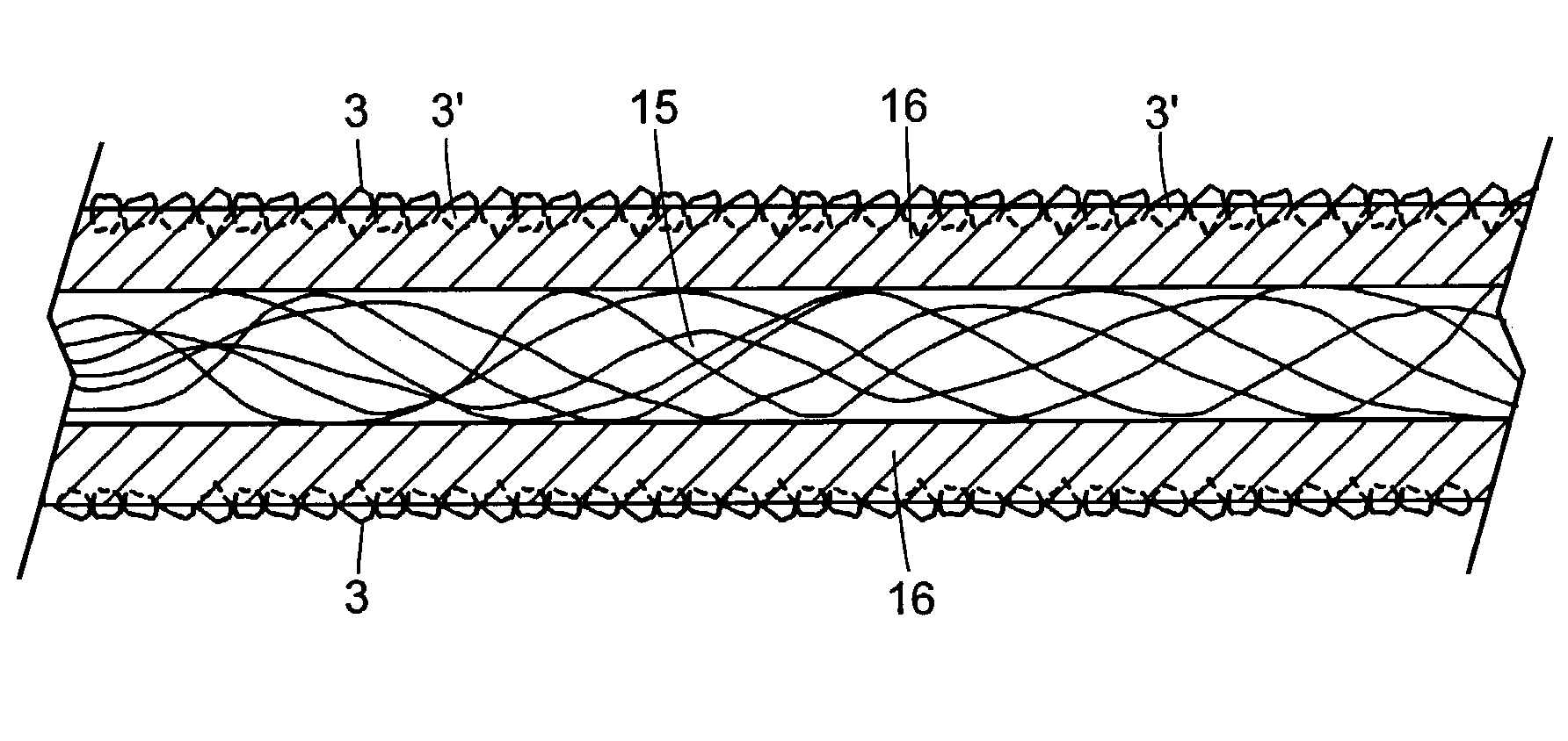 Coated multifilament dental devices overcoated with imbedded particulate