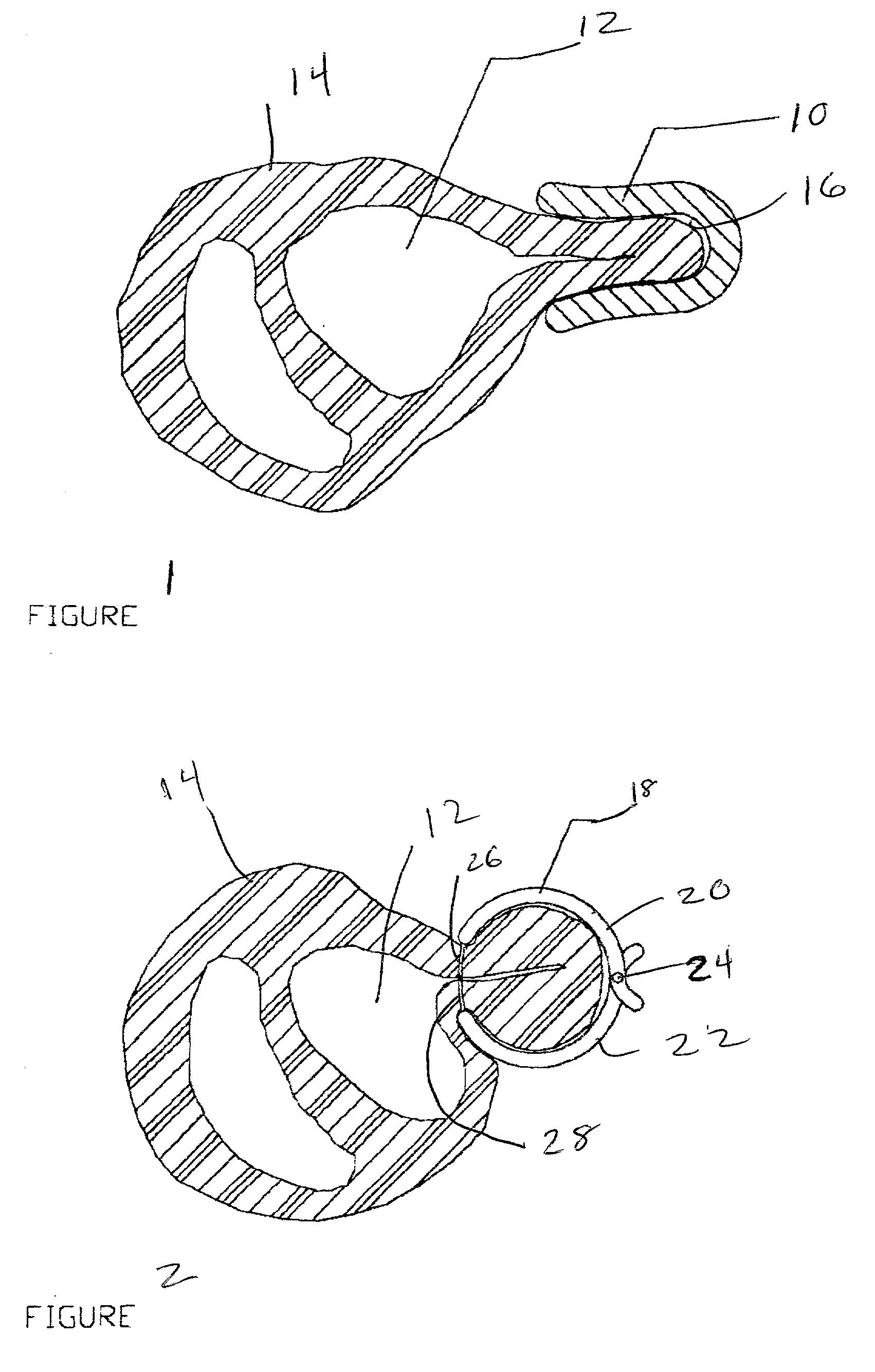 Novel device and method for treatment of congestive heart failure