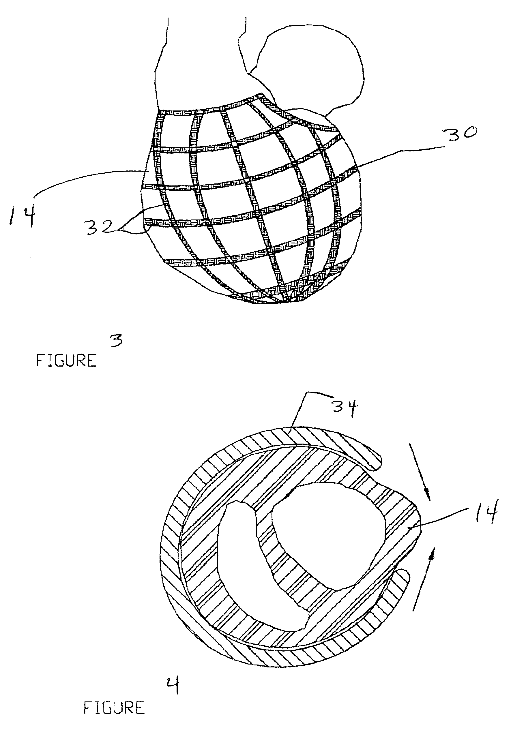 Novel device and method for treatment of congestive heart failure