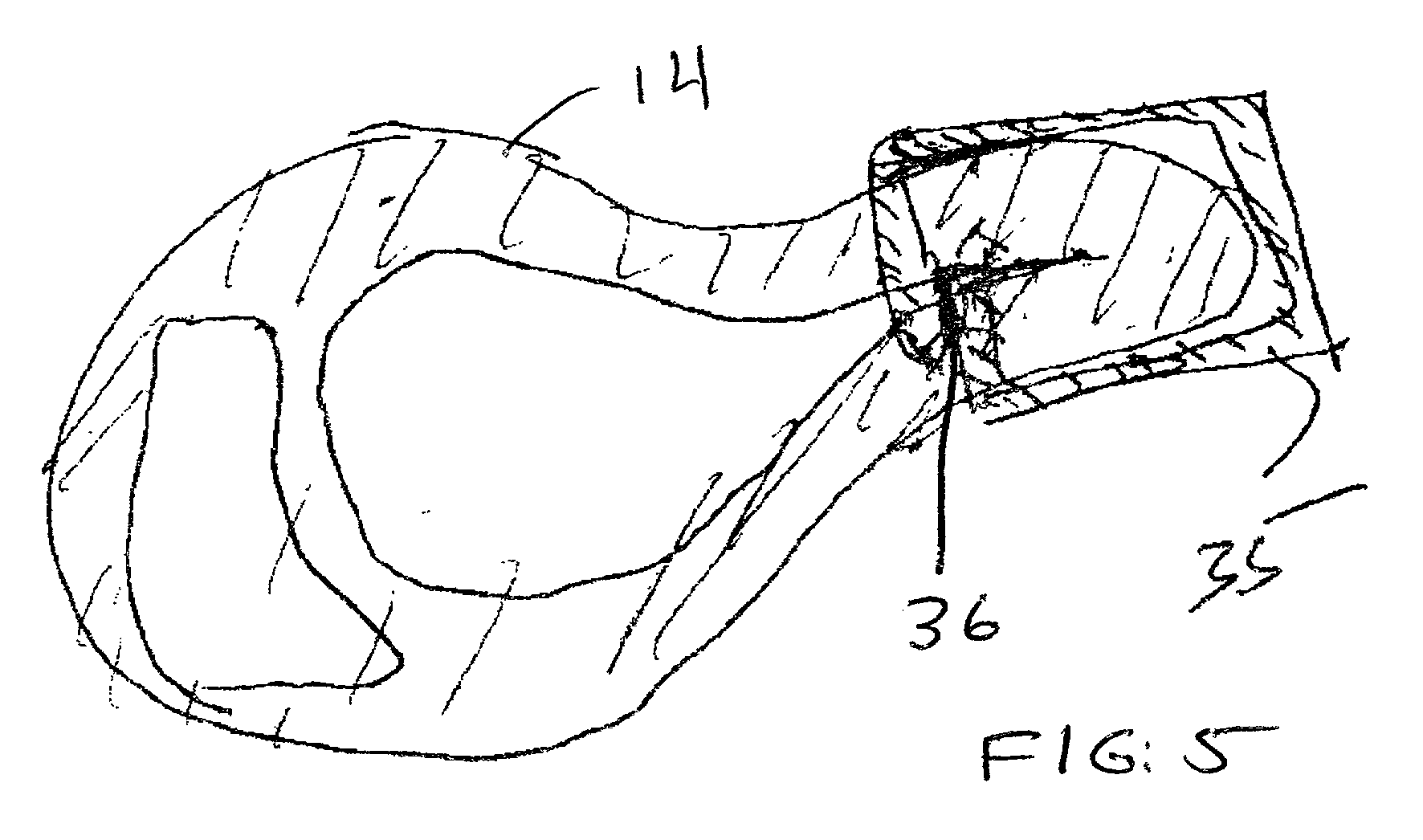 Novel device and method for treatment of congestive heart failure