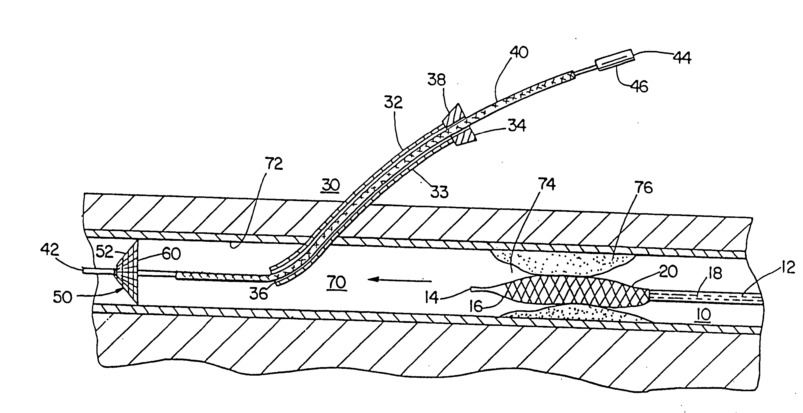 Methods of protecting a patient from embolization during surgery