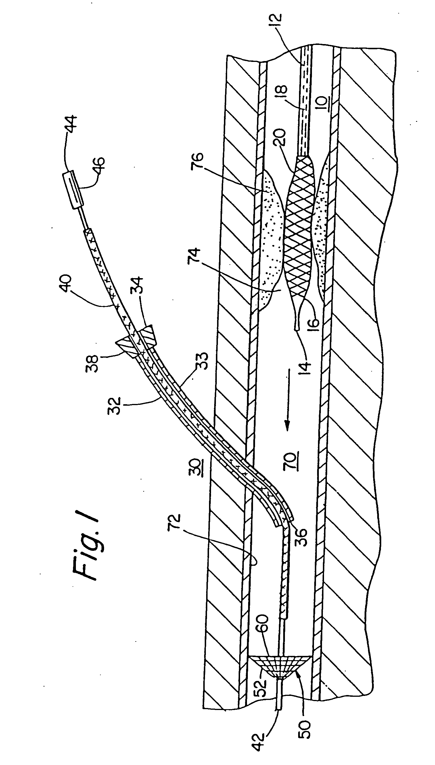 Methods of protecting a patient from embolization during surgery