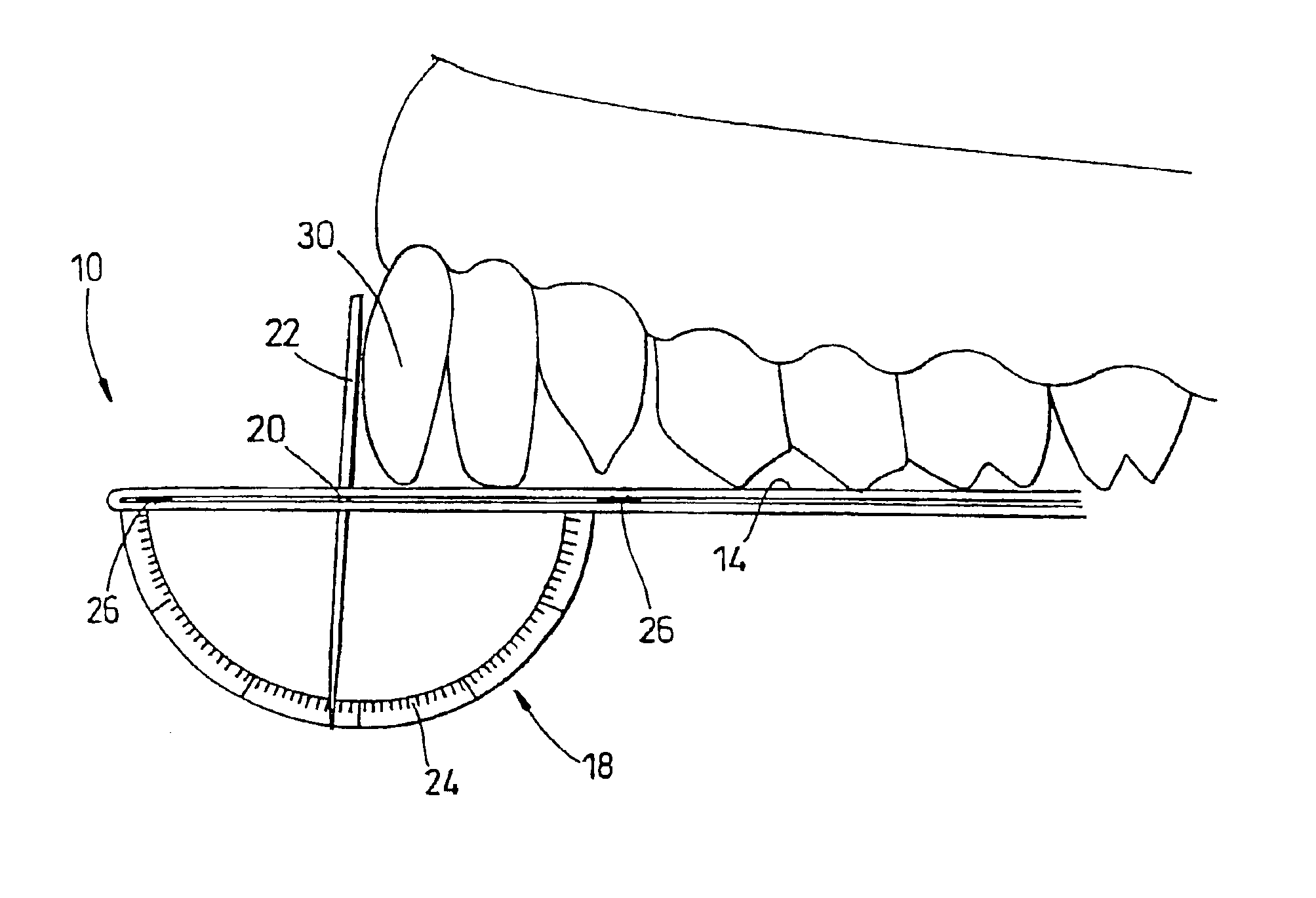 Tooth inclination assessment