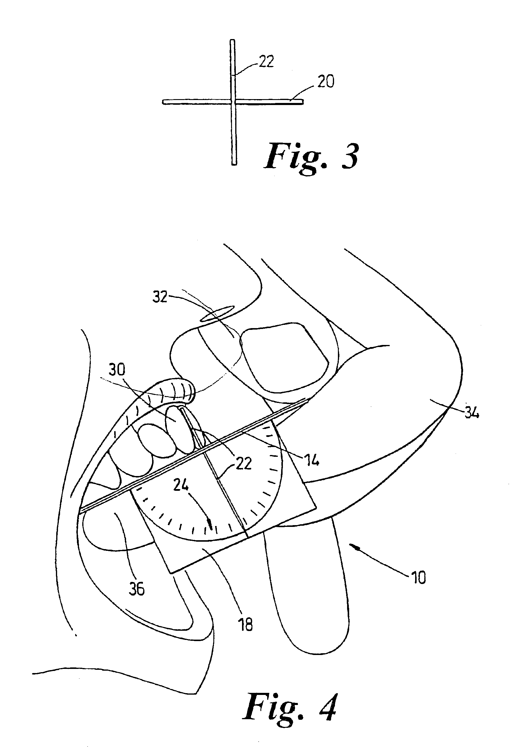 Tooth inclination assessment