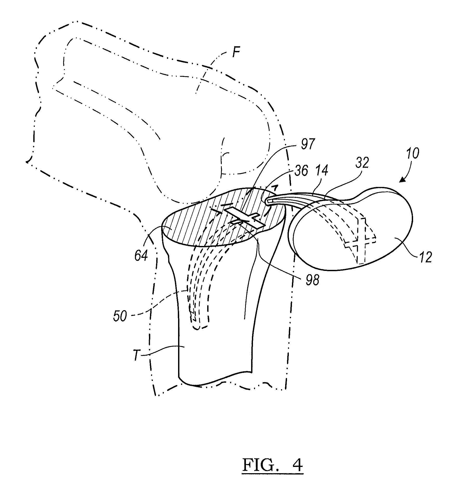 Instrumentation and method for implanting a curved stem tibial tray