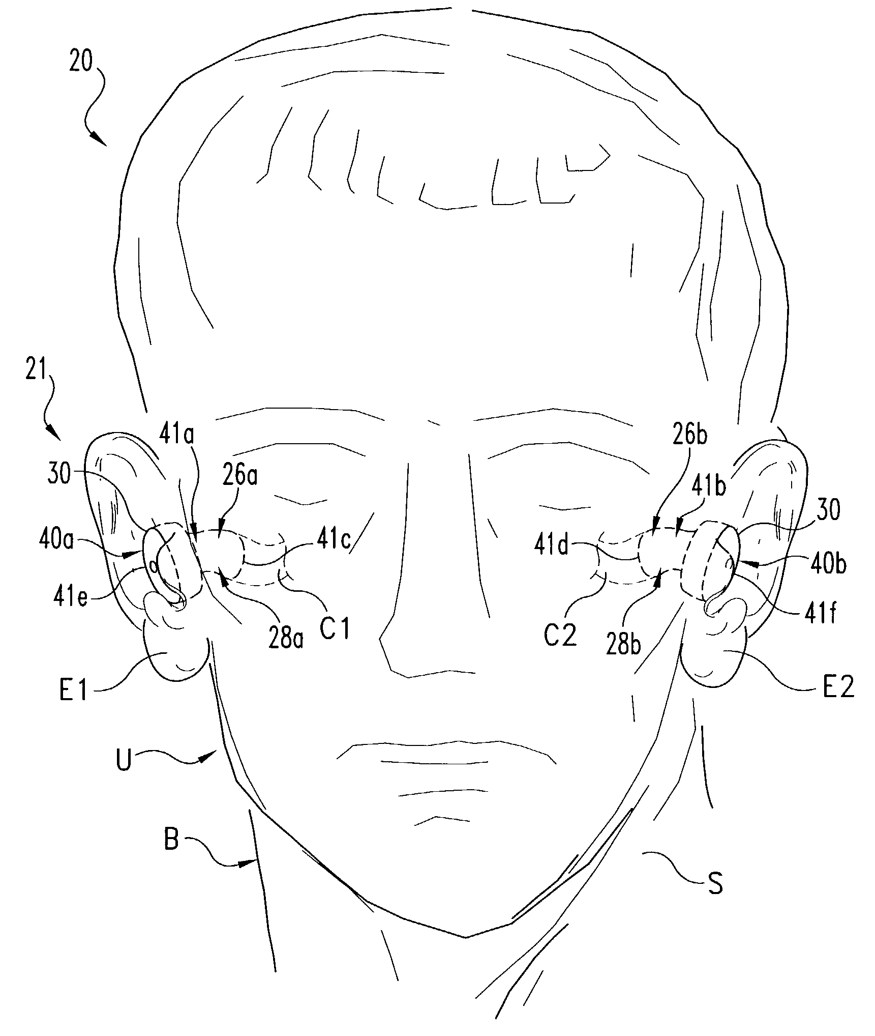 Electrode placement for wireless intrabody communication between components of a hearing system